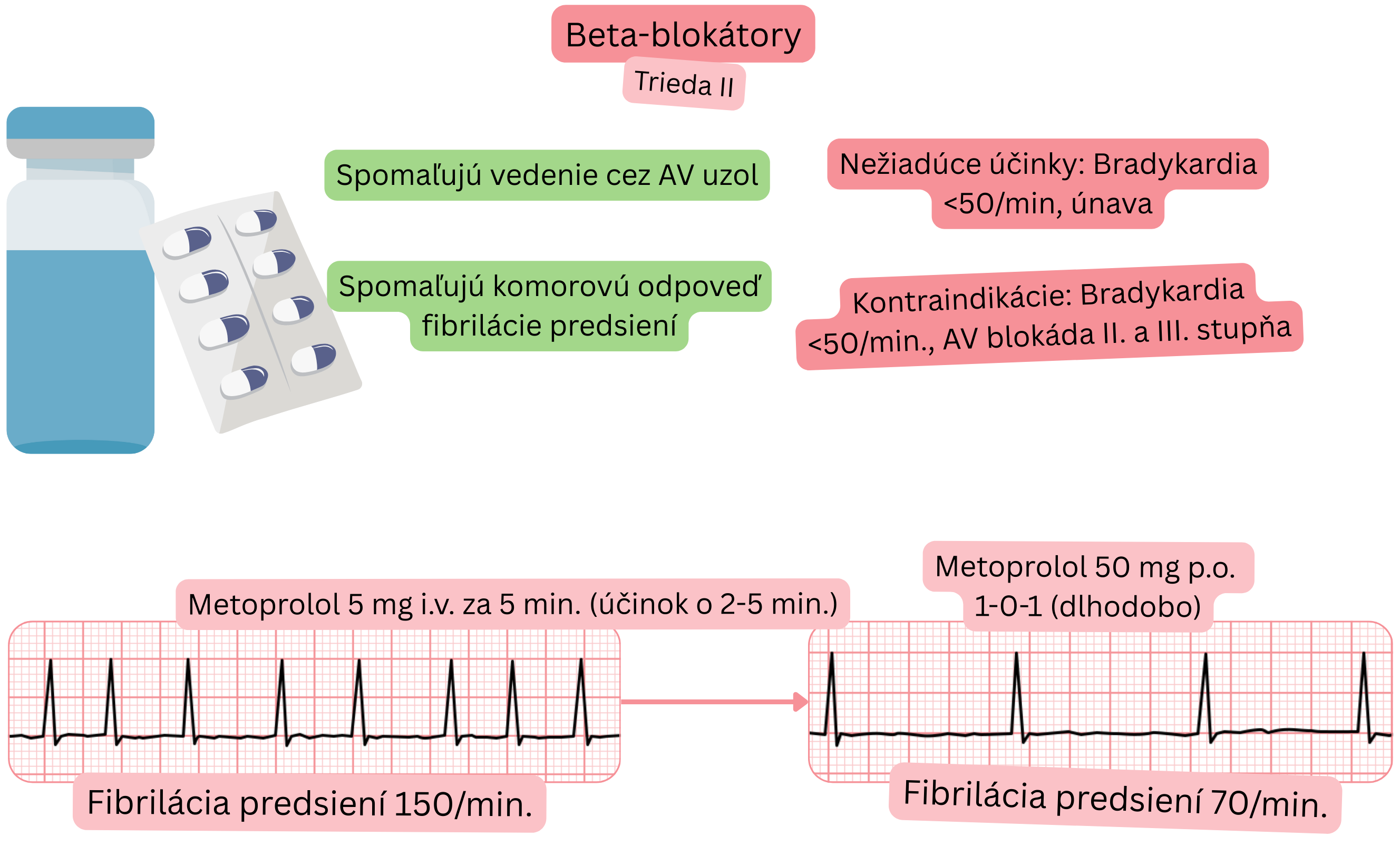 Schéma účinku betablokátorov ako antiarytmík triedy II znázorňujúca spomalenie vedenia cez atrioventrikulárny uzol a zníženie komorovej odpovede pri fibrilácii predsiení.