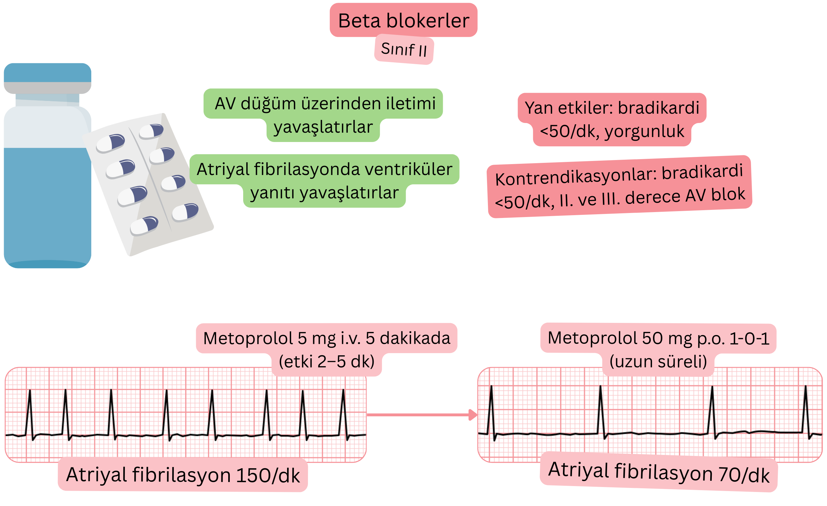 II sınıfı antiaritmik olarak beta blokerlerin etkisini gösteren şema; atriyoventriküler düğümden iletimin yavaşlamasını ve atriyal fibrilasyonda ventriküler yanıtın azalmasını göstermektedir.