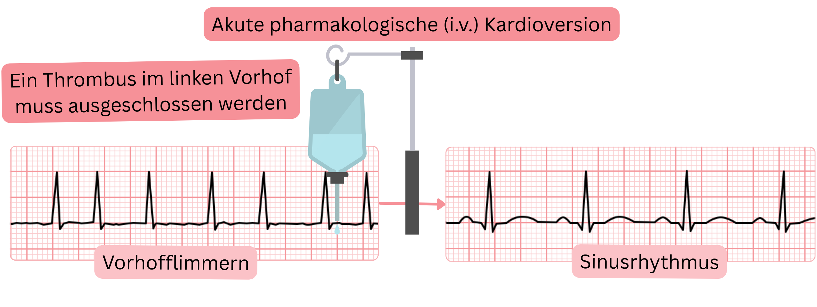 Schema der akuten pharmakologischen Kardioversion von Vorhofflimmern mit intravenösen Antiarrhythmika unter obligatorischem Ausschluss eines Thrombus im linken Vorhof vor Wiederherstellung des Sinusrhythmus.