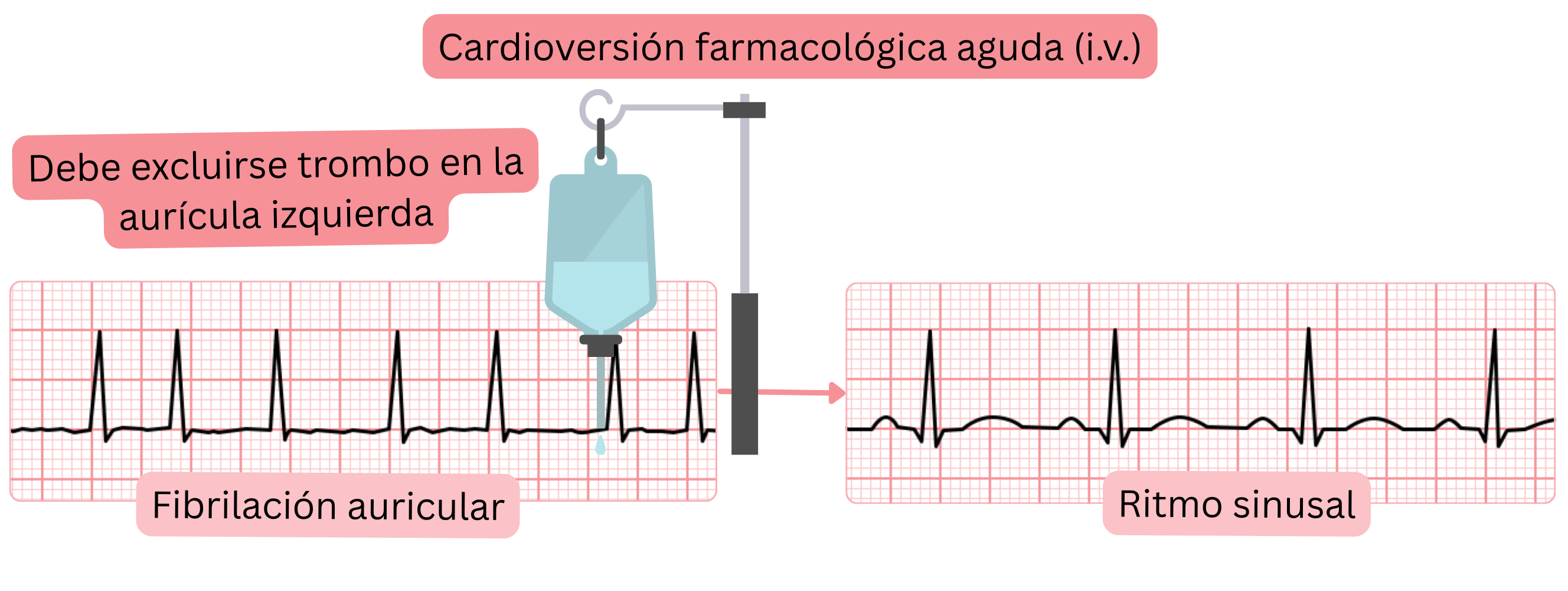 Esquema de la cardioversión farmacológica aguda de la fibrilación auricular con antiarrítmicos intravenosos, con exclusión obligatoria de trombo en la aurícula izquierda antes de restaurar el ritmo sinusal.