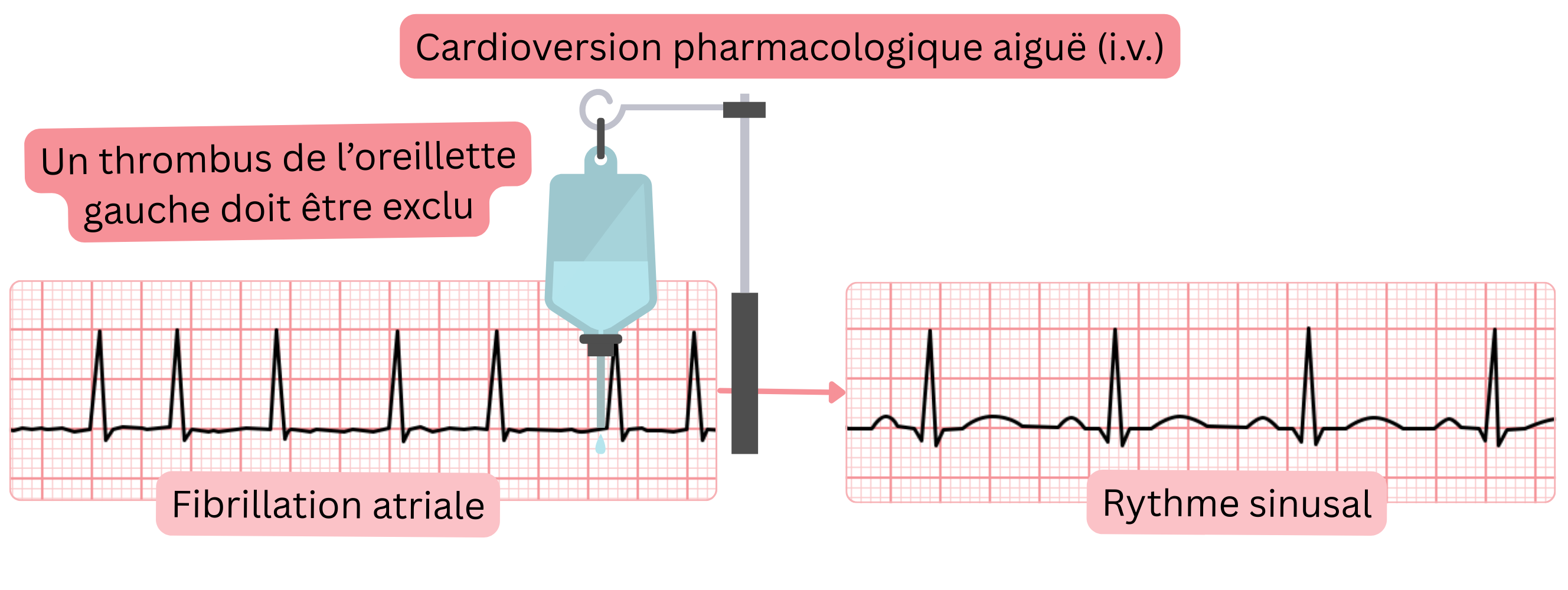 Schéma de la cardioversion pharmacologique aiguë de la fibrillation auriculaire par antiarythmiques intraveineux, avec exclusion obligatoire d’un thrombus de l’oreillette gauche avant le rétablissement du rythme sinusal.