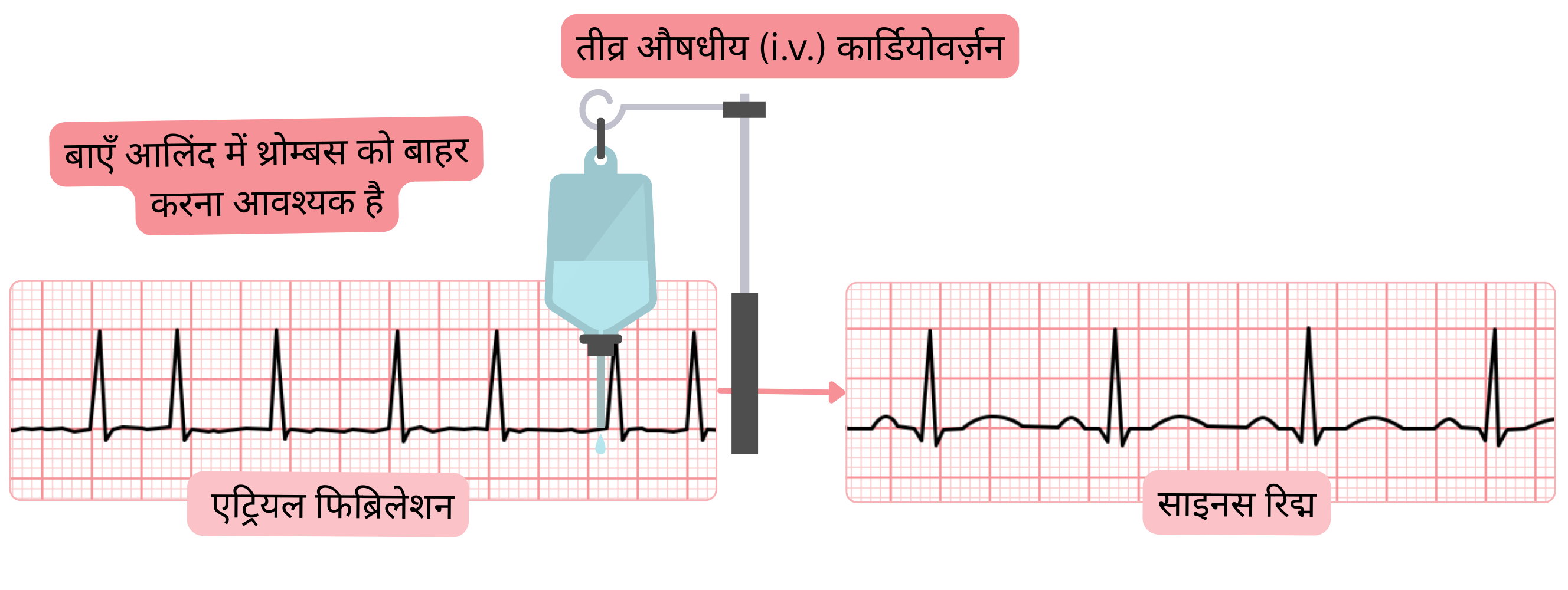 इंट्रावेनस एंटीएरिदमिक दवाओं द्वारा एट्रियल फिब्रिलेशन की तीव्र औषधीय कार्डियोवर्ज़न का आरेख, जिसमें साइनस रिद्म की पुनःस्थापना से पहले बाएँ एट्रियम में थ्रोम्बस को अनिवार्य रूप से排除 करने की आवश्यकता दर्शाई गई है।