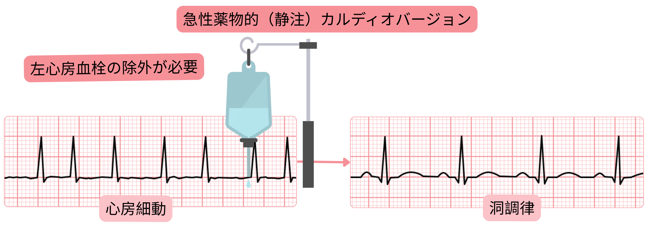 静脈内抗不整脈薬による心房細動の急性薬物的カルディオバージョンを示す模式図で、洞調律回復前に左心房血栓を必ず除外する必要性を示す。