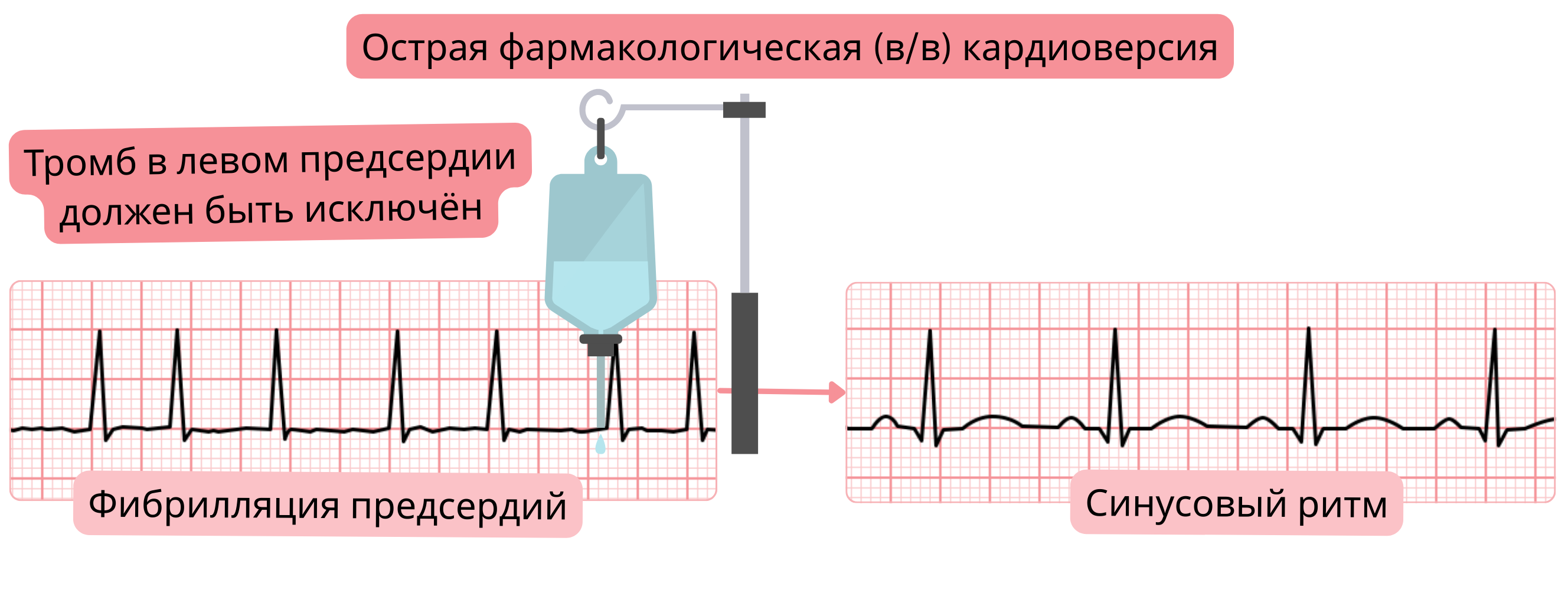 Схема острой фармакологической кардиоверсии фибрилляции предсердий внутривенными антиаритмическими препаратами с обязательным исключением тромба в левом предсердии перед восстановлением синусового ритма.