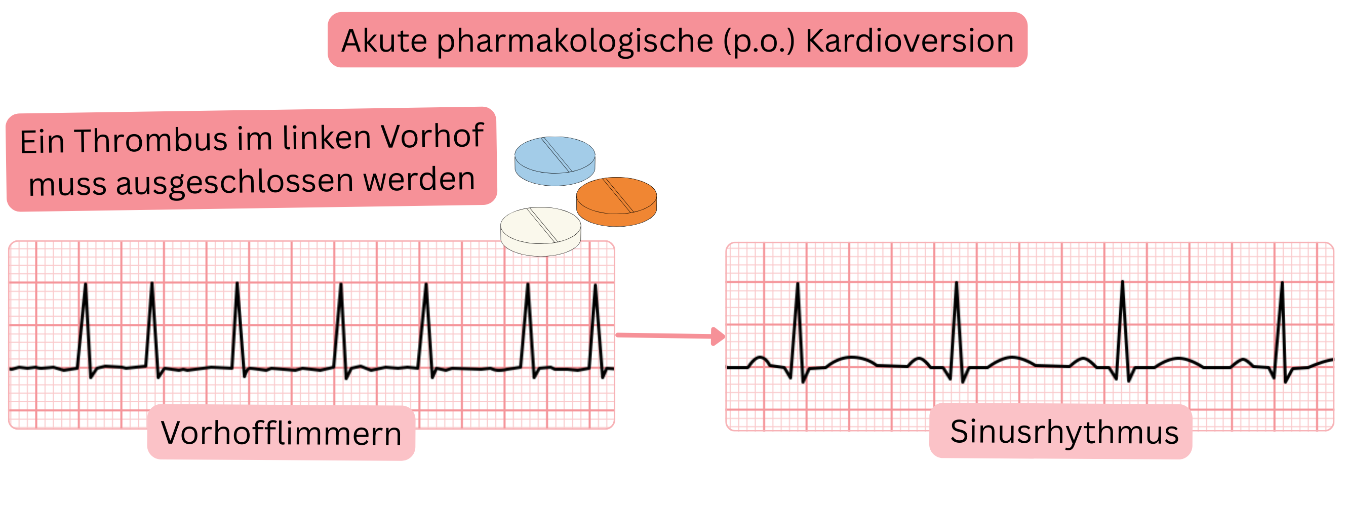 Schema der akuten pharmakologischen Kardioversion von Vorhofflimmern mit oralen Antiarrhythmika, das die Notwendigkeit des Ausschlusses eines Thrombus im linken Vorhof vor Wiederherstellung des Sinusrhythmus darstellt.