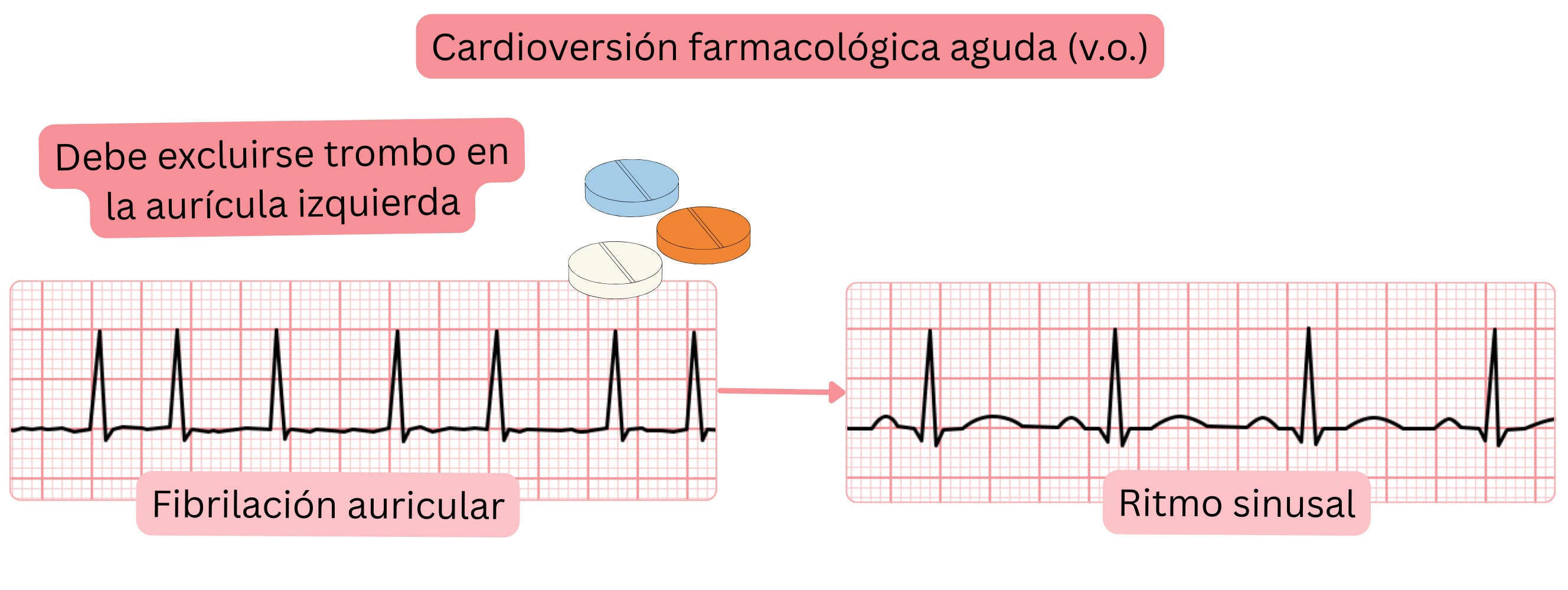 Esquema de la cardioversión farmacológica aguda de la fibrilación auricular con antiarrítmicos orales, destacando la necesidad de excluir trombo en la aurícula izquierda antes de restaurar el ritmo sinusal.