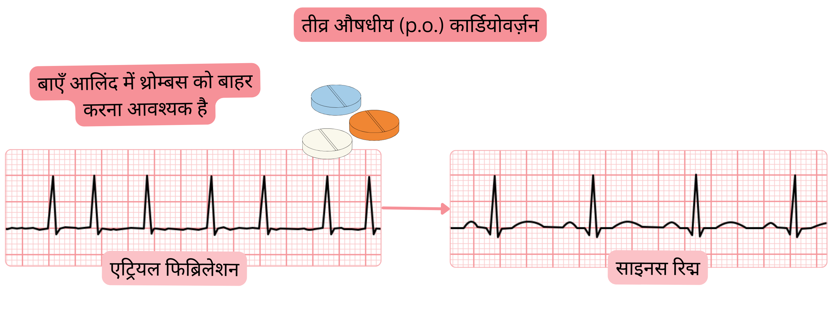 मौखिक एंटीएरिदमिक दवाओं द्वारा एट्रियल फिब्रिलेशन की तीव्र औषधीय कार्डियोवर्ज़न का आरेख, जिसमें साइनस रिद्म की पुनःस्थापना से पहले बाएँ एट्रियम में थ्रोम्बस को排除 करने की आवश्यकता दर्शाई गई है।
