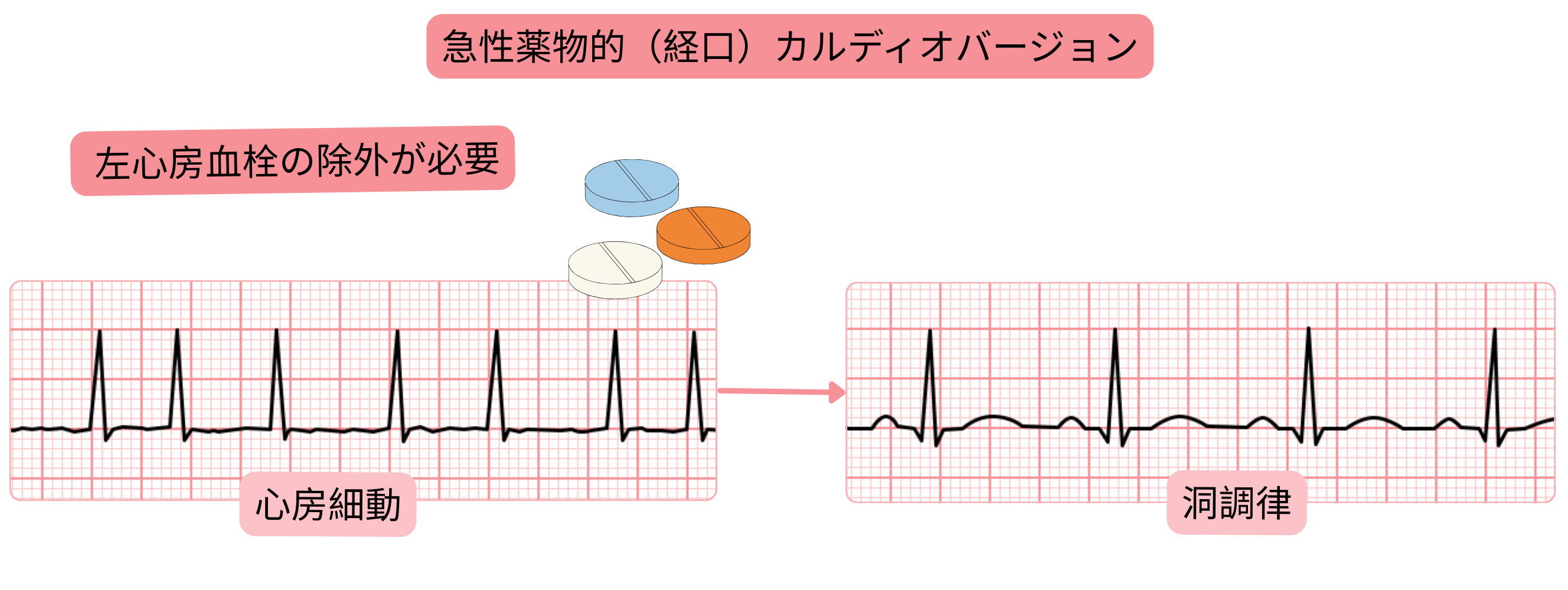 経口抗不整脈薬による心房細動の急性薬物的カルディオバージョンを示す模式図で、洞調律回復前に左心房血栓を除外する必要性を示す。
