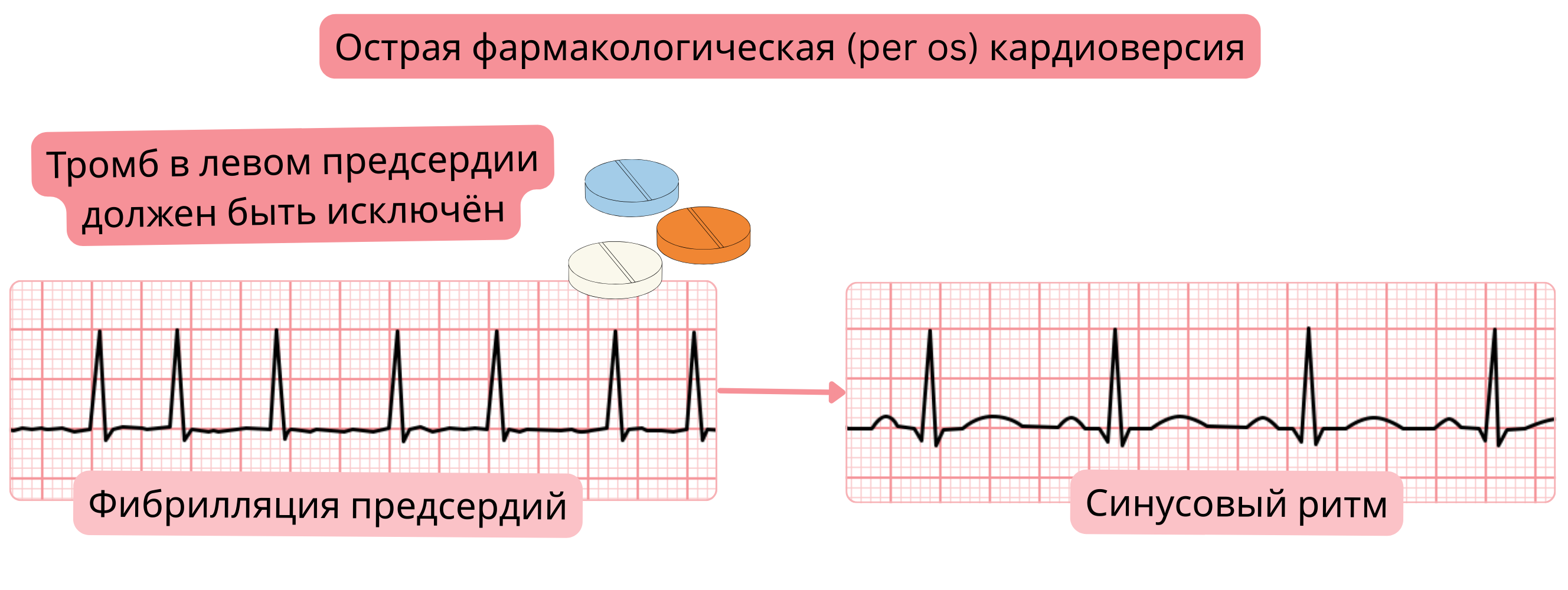 Схема острой фармакологической кардиоверсии фибрилляции предсердий пероральными антиаритмическими препаратами с необходимостью исключения тромба в левом предсердии перед восстановлением синусового ритма.