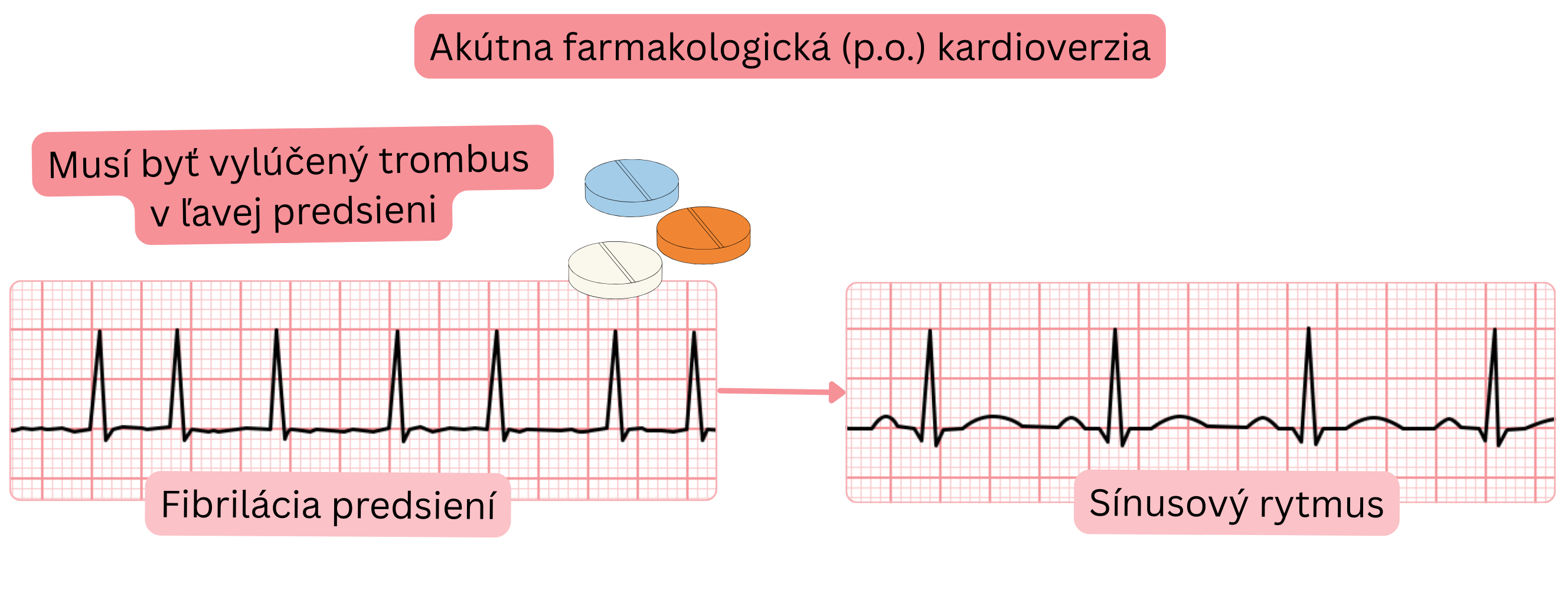 Schéma akútnej farmakologickej kardioverzie fibrilácie predsiení perorálnymi antiarytmikami s nutnosťou vylúčenia trombu v ľavej predsieni pred obnovením sínusového rytmu.