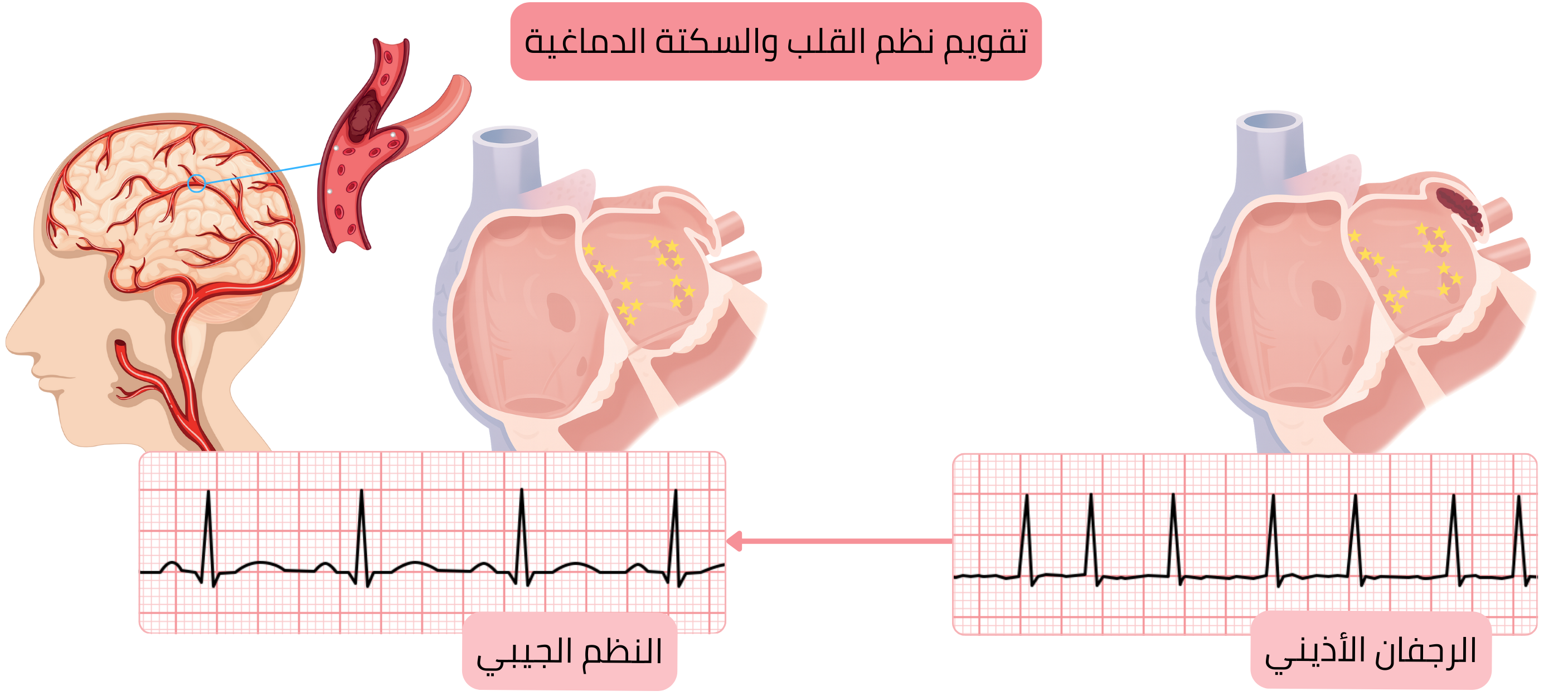 مخطط يوضح خطر السكتة الدماغية بعد تقويم نظم الرجفان الأذيني نتيجة تحرك خثرة من الأذين الأيسر عند استعادة النظم الجيبي.