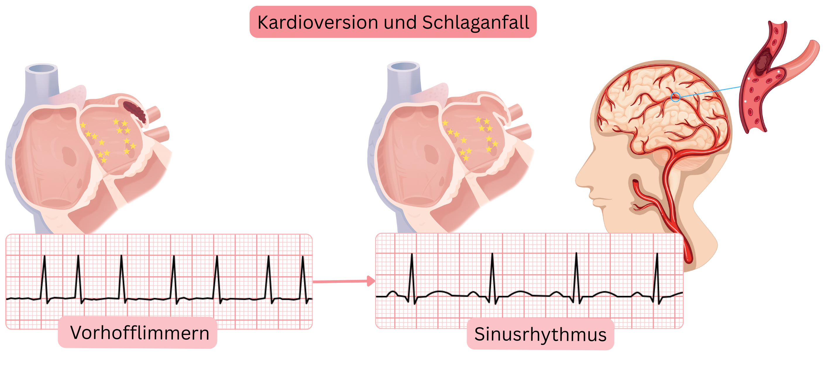 Schema zur Darstellung des Schlaganfallrisikos nach Kardioversion von Vorhofflimmern infolge der Mobilisierung eines Thrombus aus dem linken Vorhof bei Wiederherstellung des Sinusrhythmus.