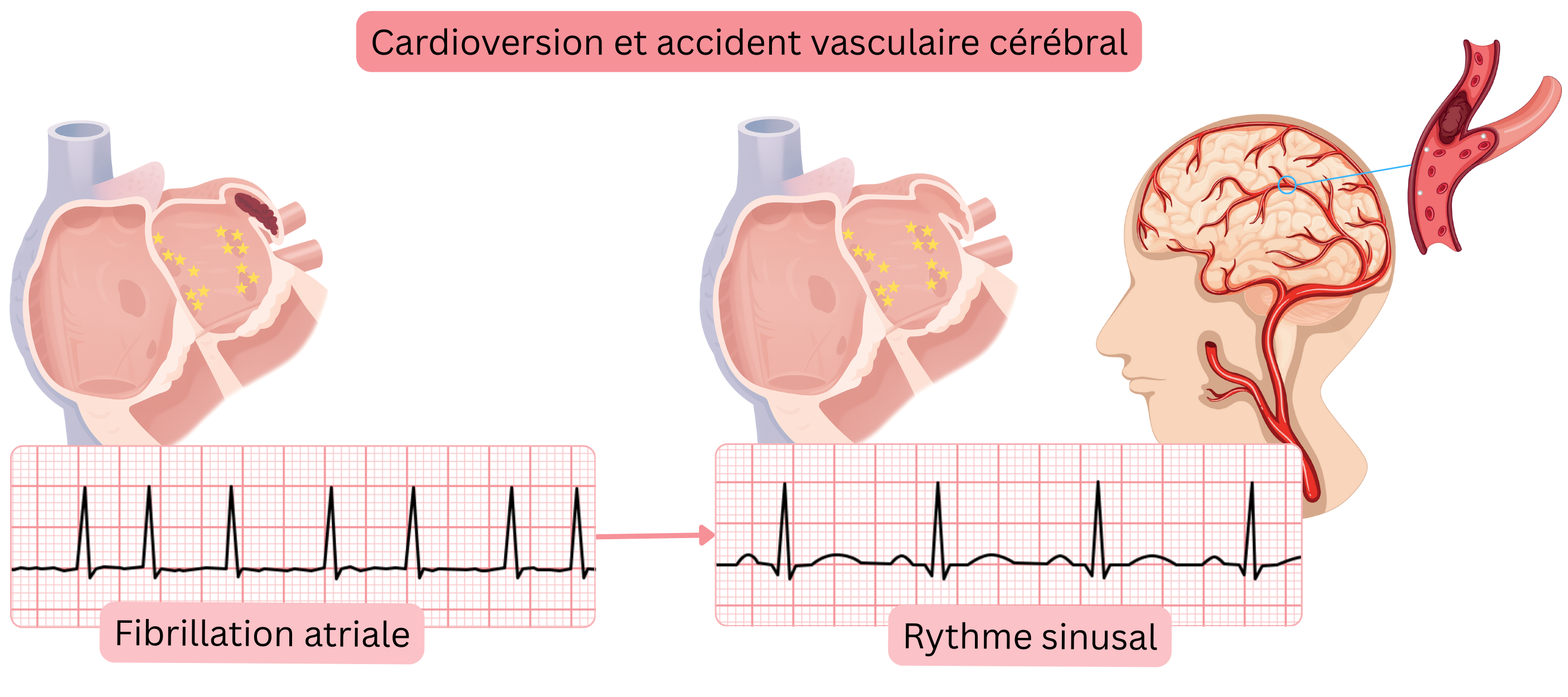 Schéma illustrant le risque d’accident vasculaire cérébral après la cardioversion de la fibrillation auriculaire en raison de la mobilisation d’un thrombus de l’oreillette gauche lors du rétablissement du rythme sinusal.