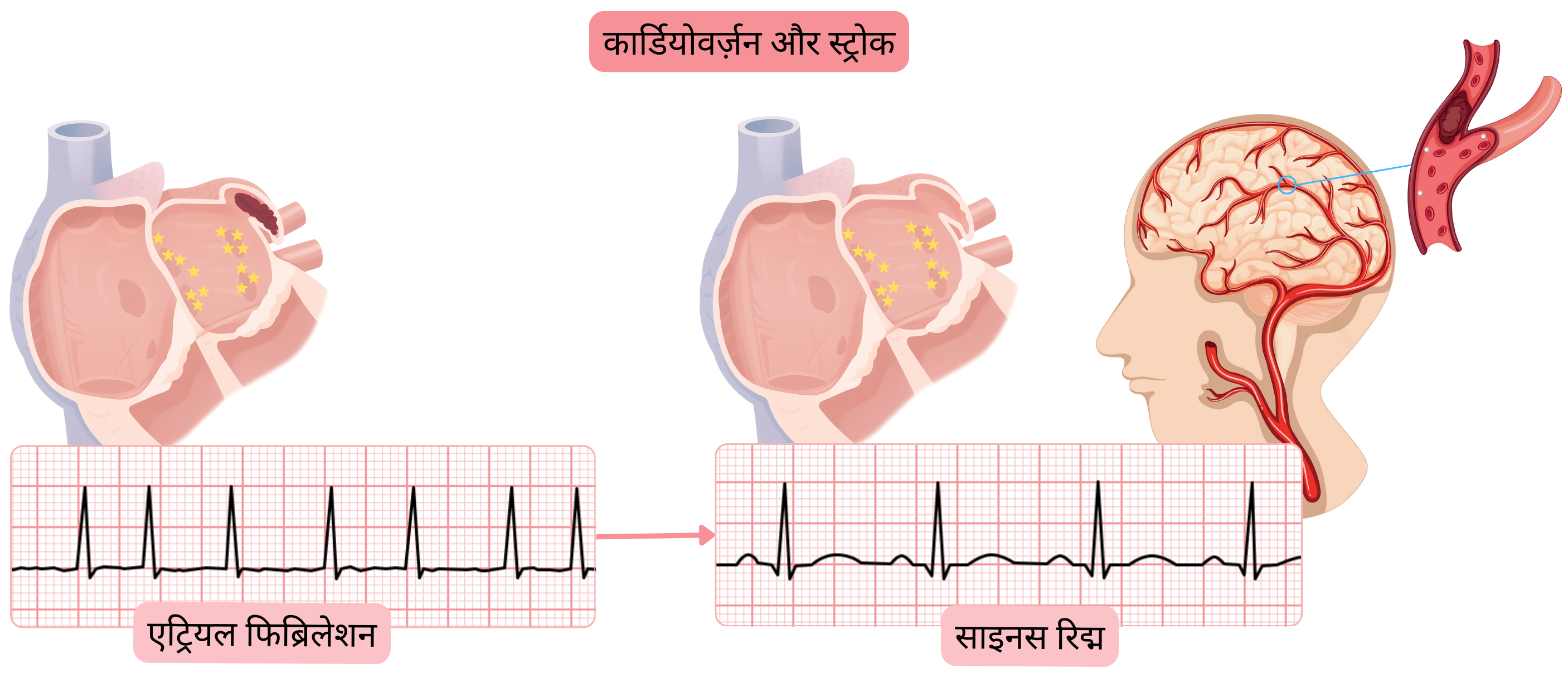 एट्रियल फिब्रिलेशन की कार्डियोवर्ज़न के बाद स्ट्रोक के जोखिम का आरेख, जिसमें साइनस रिद्म की पुनःस्थापना पर बाएँ एट्रियम से थ्रोम्बस के गतिशील होने को दर्शाया गया है।