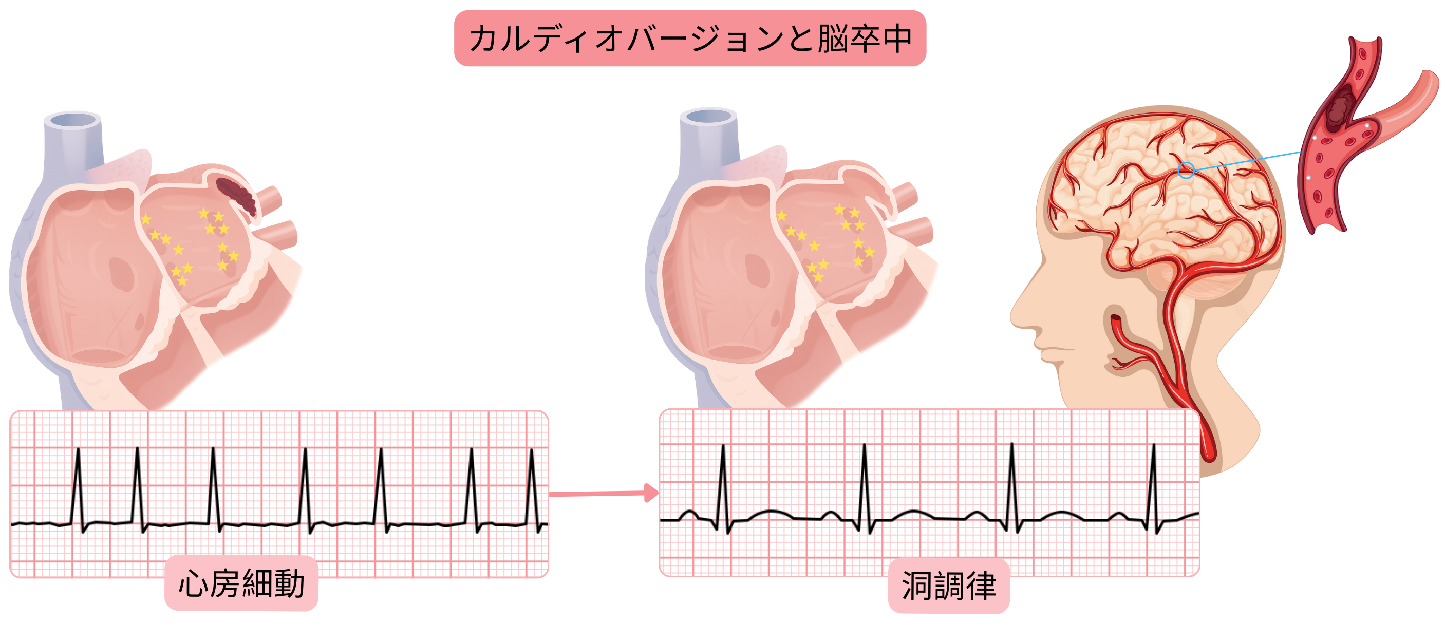 心房細動のカルディオバージョン後に洞調律が回復することで左心房内血栓が動員され、脳卒中リスクが高まることを示す模式図。