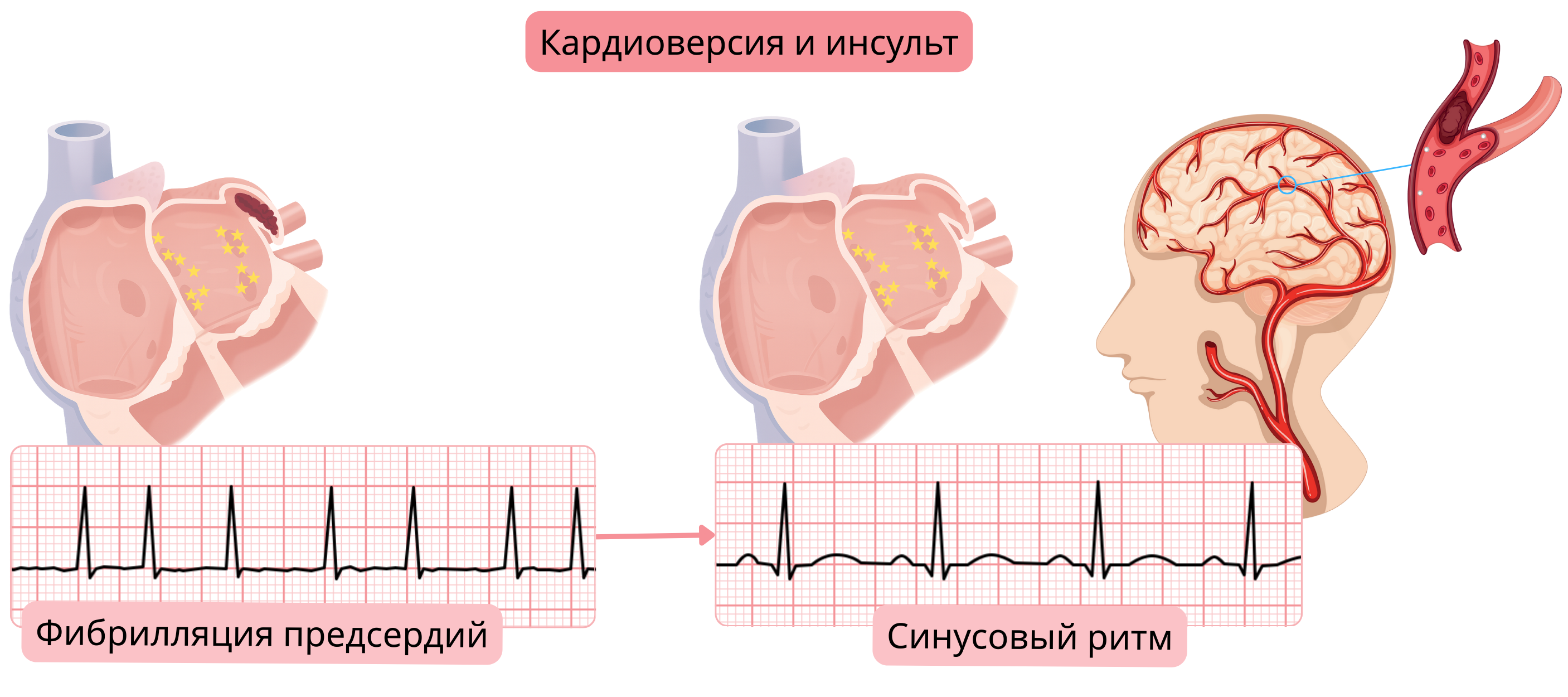 Схема, демонстрирующая риск инсульта после кардиоверсии фибрилляции предсердий вследствие мобилизации тромба из левого предсердия при восстановлении синусового ритма.