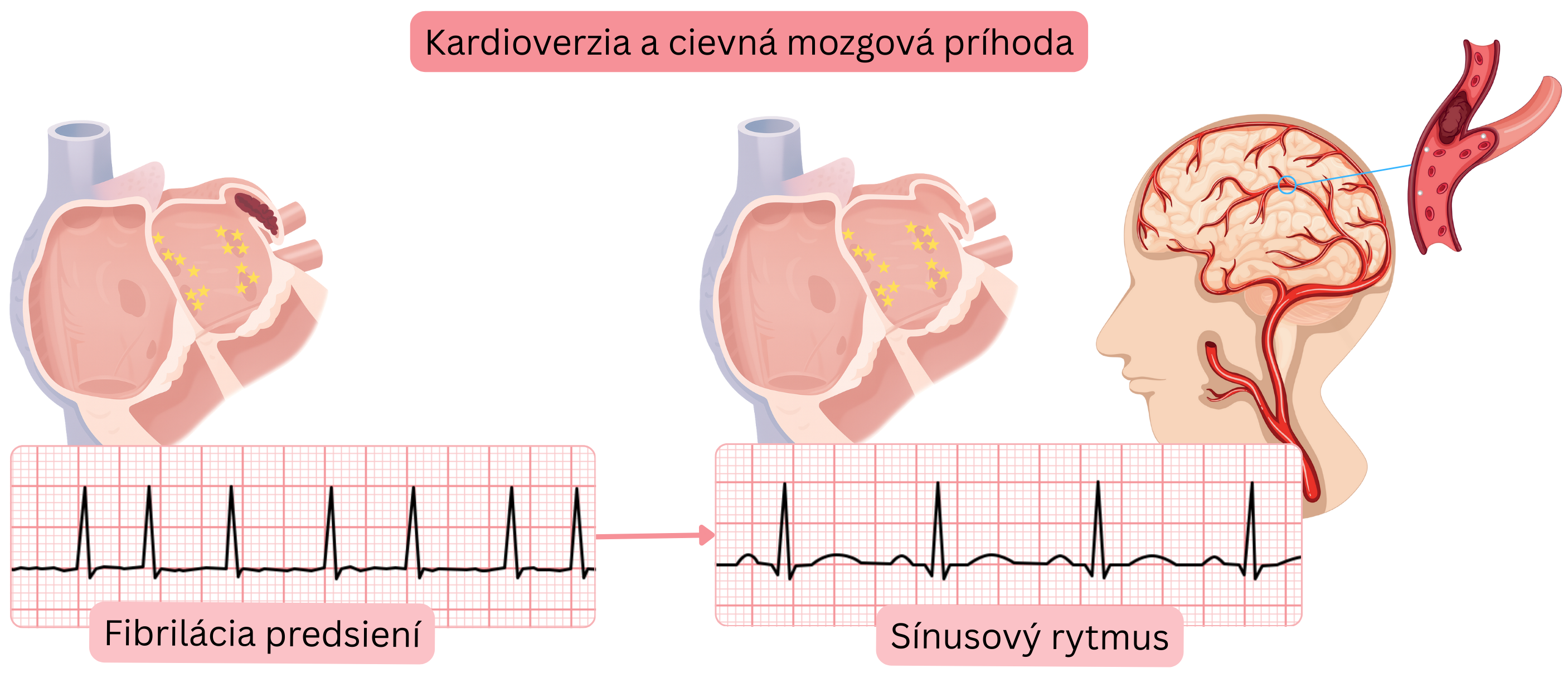 Schéma znázorňujúca riziko cievnej mozgovej príhody po kardioverzii fibrilácie predsiení v dôsledku mobilizácie trombu z ľavej predsiene pri obnovení sínusového rytmu.