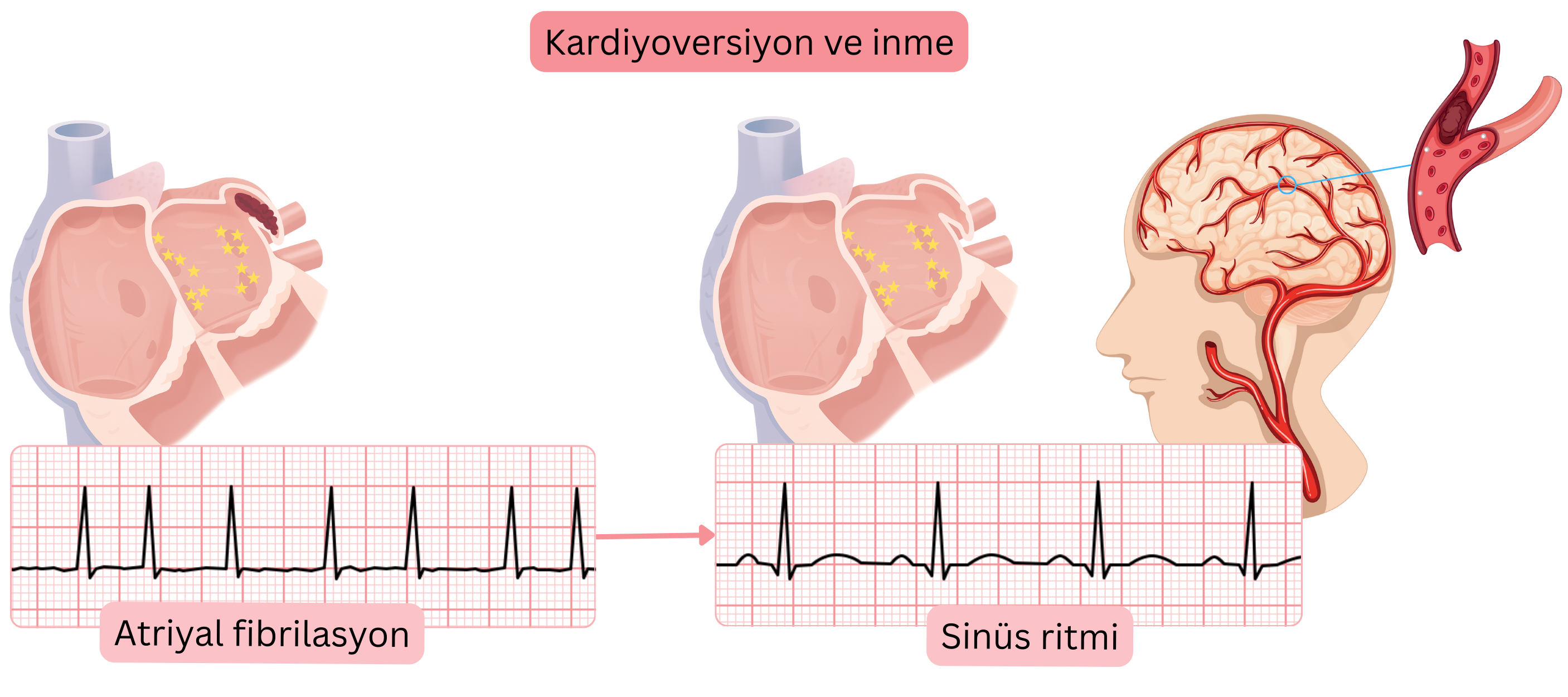 Atriyal fibrilasyon kardiyoversiyonu sonrasında sinüs ritminin yeniden sağlanmasıyla sol atriyumdan trombüs mobilizasyonuna bağlı inme riskini gösteren şema.