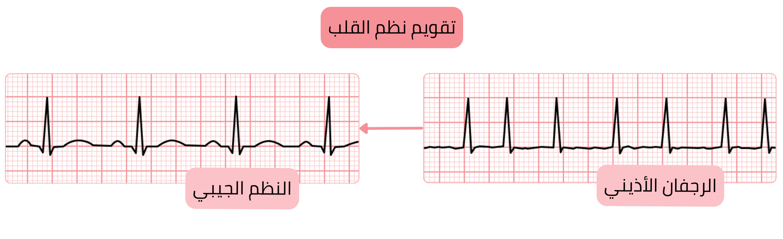 مخطط تقويم النظم يوضح الانتقال من الرجفان الأذيني إلى النظم الجيبي موثقًا بتغيرات تخطيط القلب.