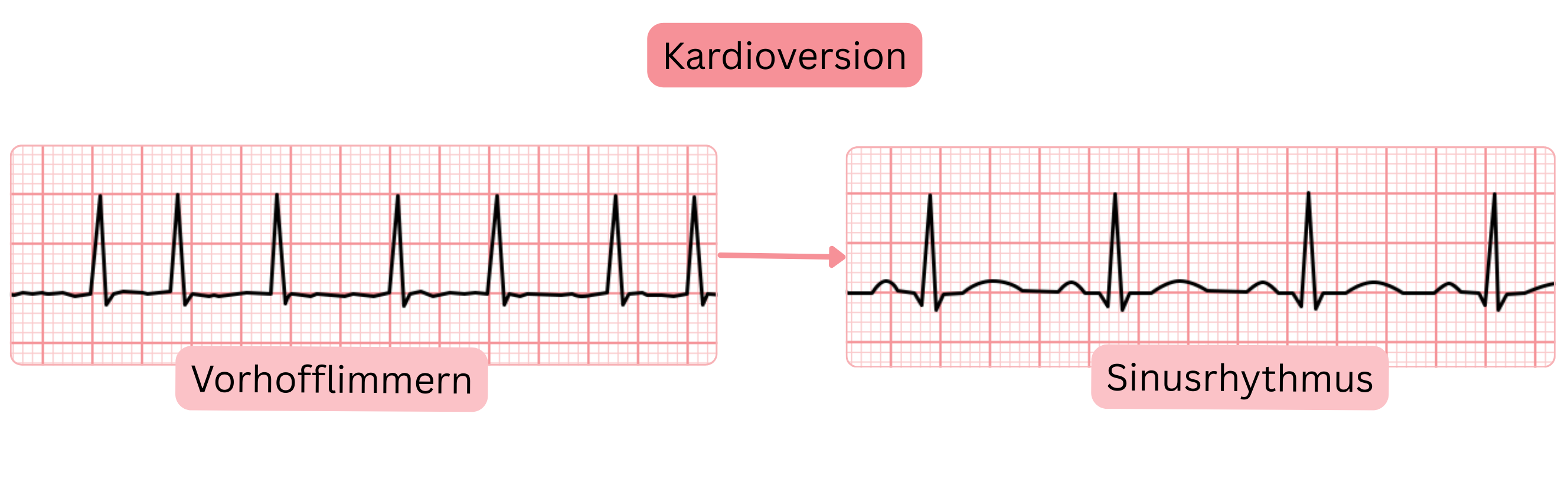 Schema der Kardioversion mit Darstellung des Übergangs von Vorhofflimmern zum Sinusrhythmus, dokumentiert durch Veränderungen im EKG.