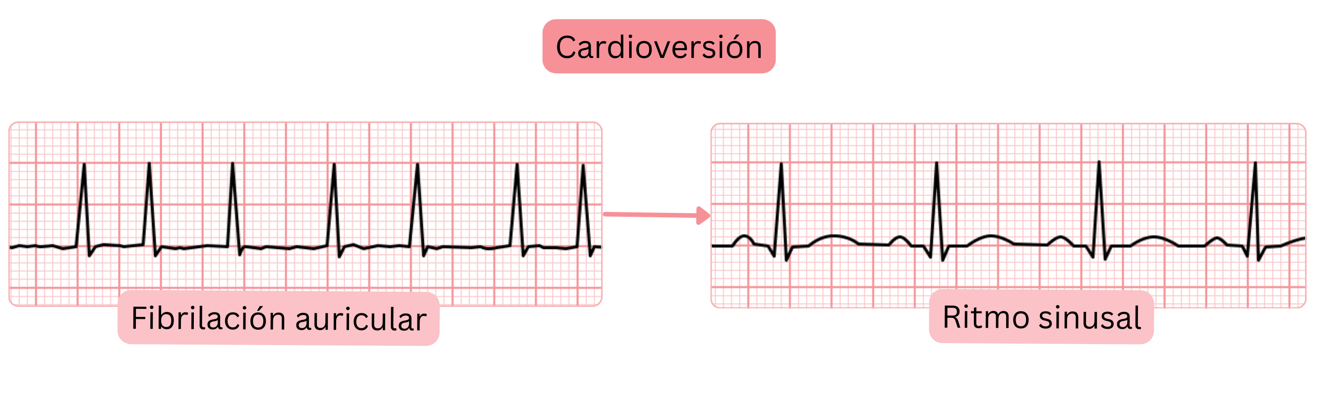 Esquema de cardioversión que muestra la transición de fibrilación auricular a ritmo sinusal documentada mediante cambios en el registro del ECG.