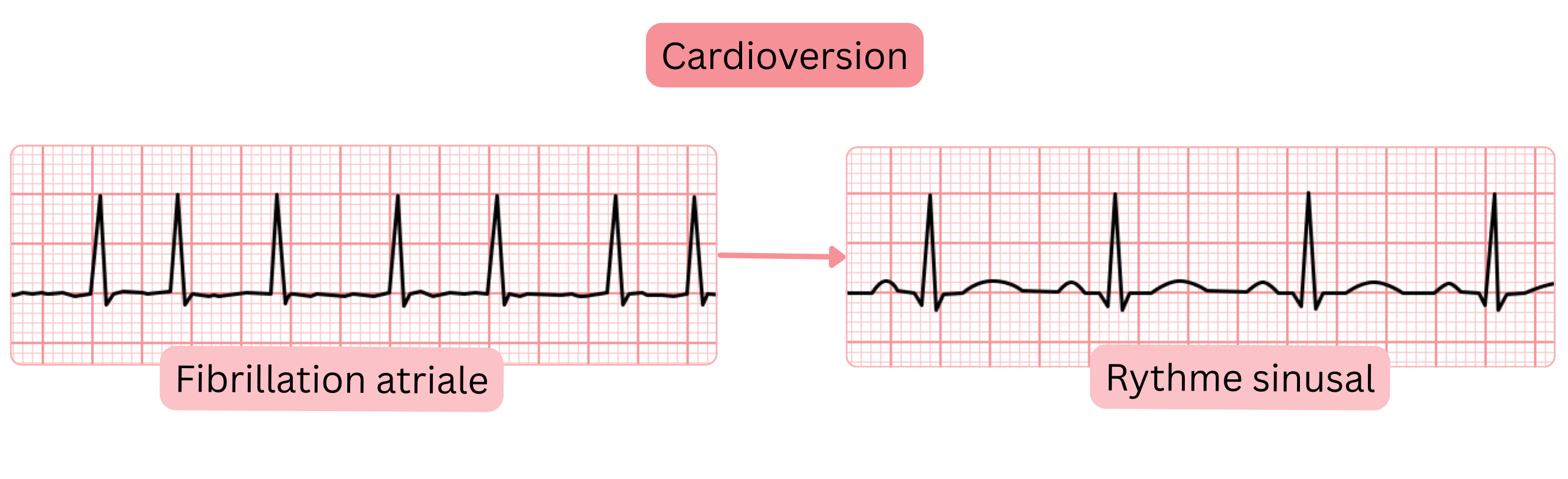 Schéma de cardioversion illustrant le passage de la fibrillation auriculaire au rythme sinusal, documenté par la modification de l’enregistrement ECG.