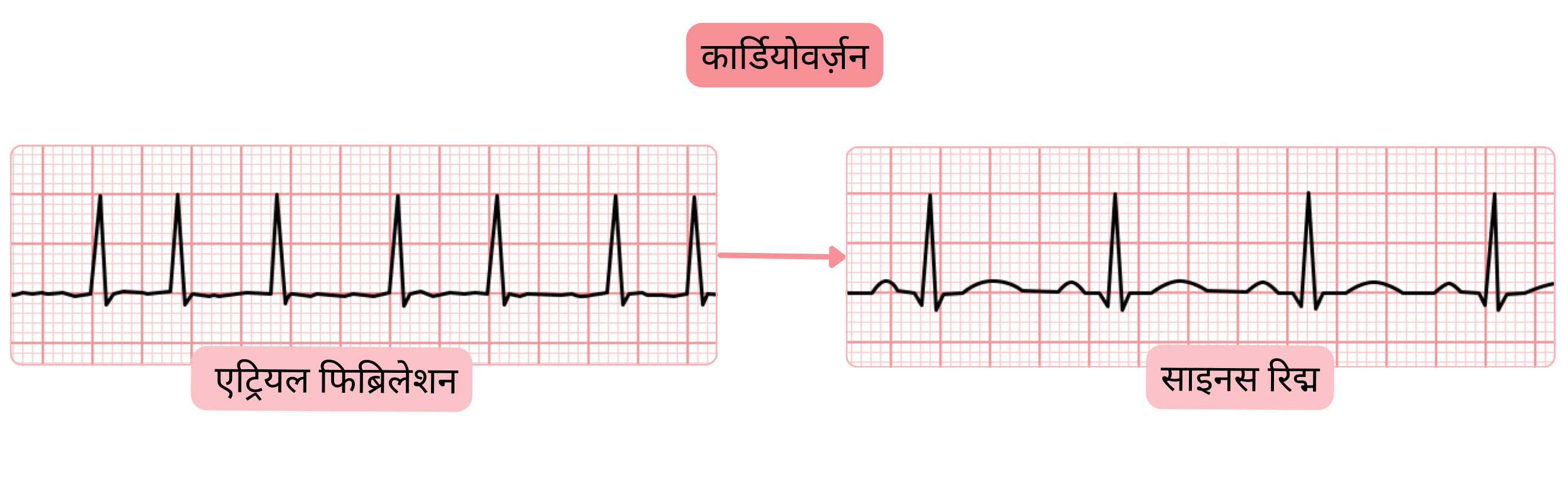 कार्डियोवर्ज़न का आरेख, जिसमें ईसीजी रिकॉर्डिंग में परिवर्तन द्वारा एट्रियल फिब्रिलेशन से साइनस रिद्म में परिवर्तन को दर्शाया गया है।