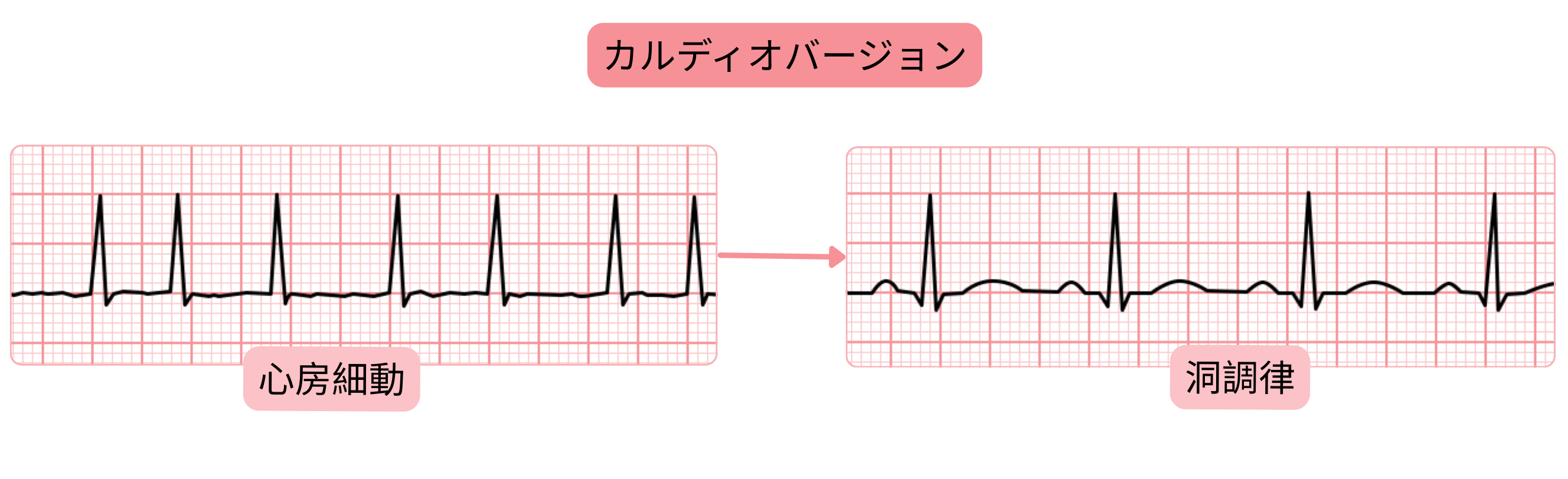 心電図記録の変化により示された、心房細動から洞調律への移行を示すカルディオバージョンの模式図。
