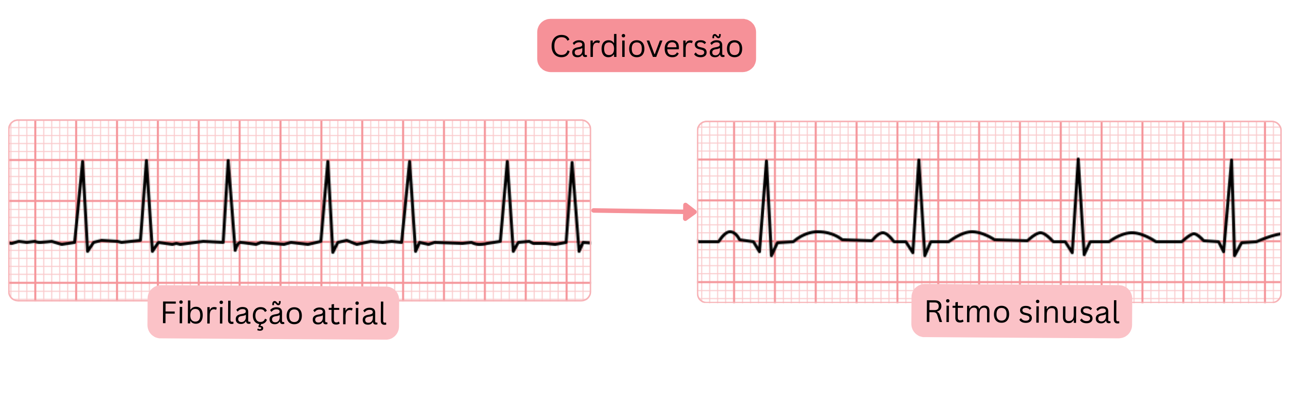 Esquema de cardioversão demonstrando a transição da fibrilação atrial para o ritmo sinusal documentada por alterações no registro do ECG.