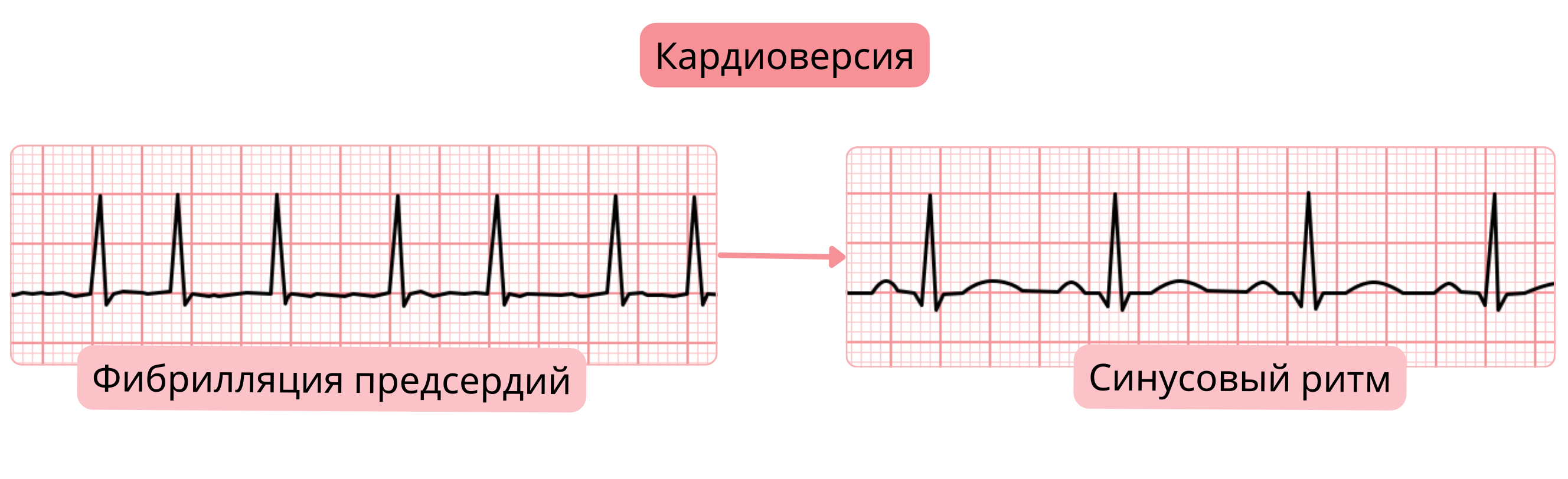 Схема кардиоверсии, демонстрирующая переход от фибрилляции предсердий к синусовому ритму, зафиксированный изменениями на ЭКГ.