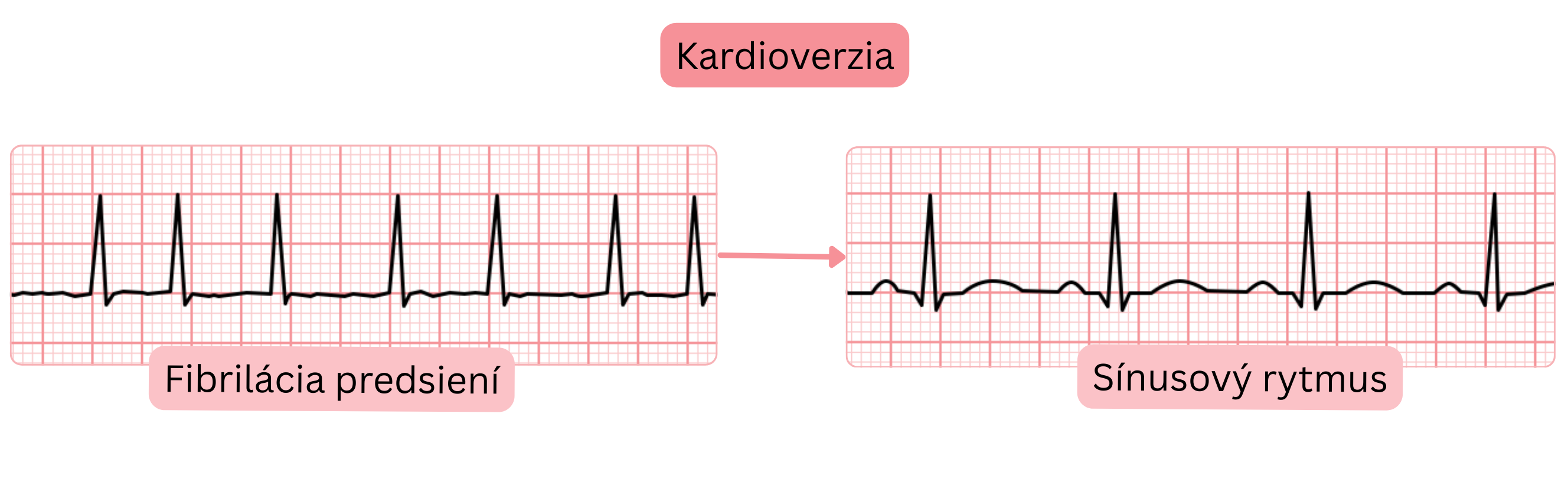 Schéma kardioverzie znázorňujúca prechod z fibrilácie predsiení na sínusový rytmus dokumentovaný zmenou EKG záznamu.