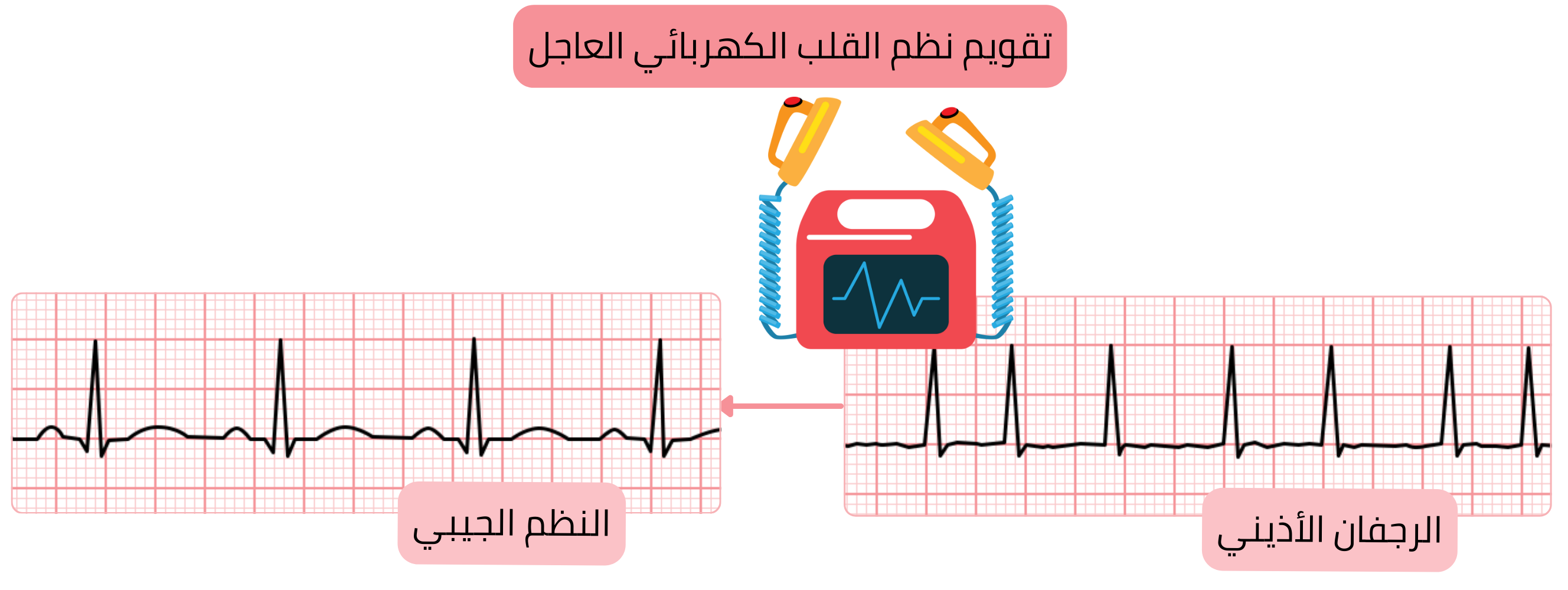 مخطط التقويم القلبي الكهربائي الإسعافي يوضح الاستعادة الفورية للنظم الجيبي في الرجفان الأذيني باستخدام صدمة كهربائية متزامنة.