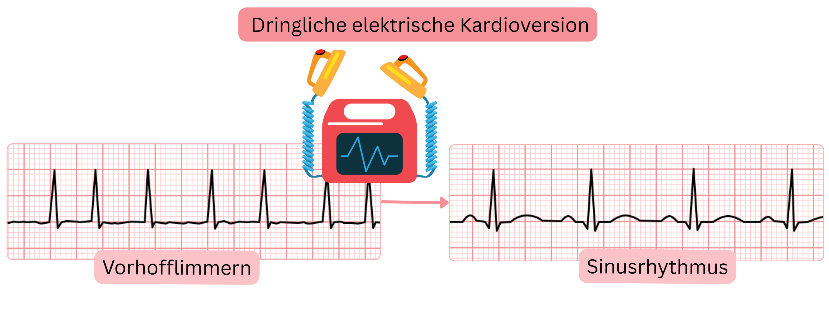 Schema der dringlichen elektrischen Kardioversion mit Darstellung der sofortigen Wiederherstellung des Sinusrhythmus bei Vorhofflimmern mittels synchronisiertem elektrischem Schock.