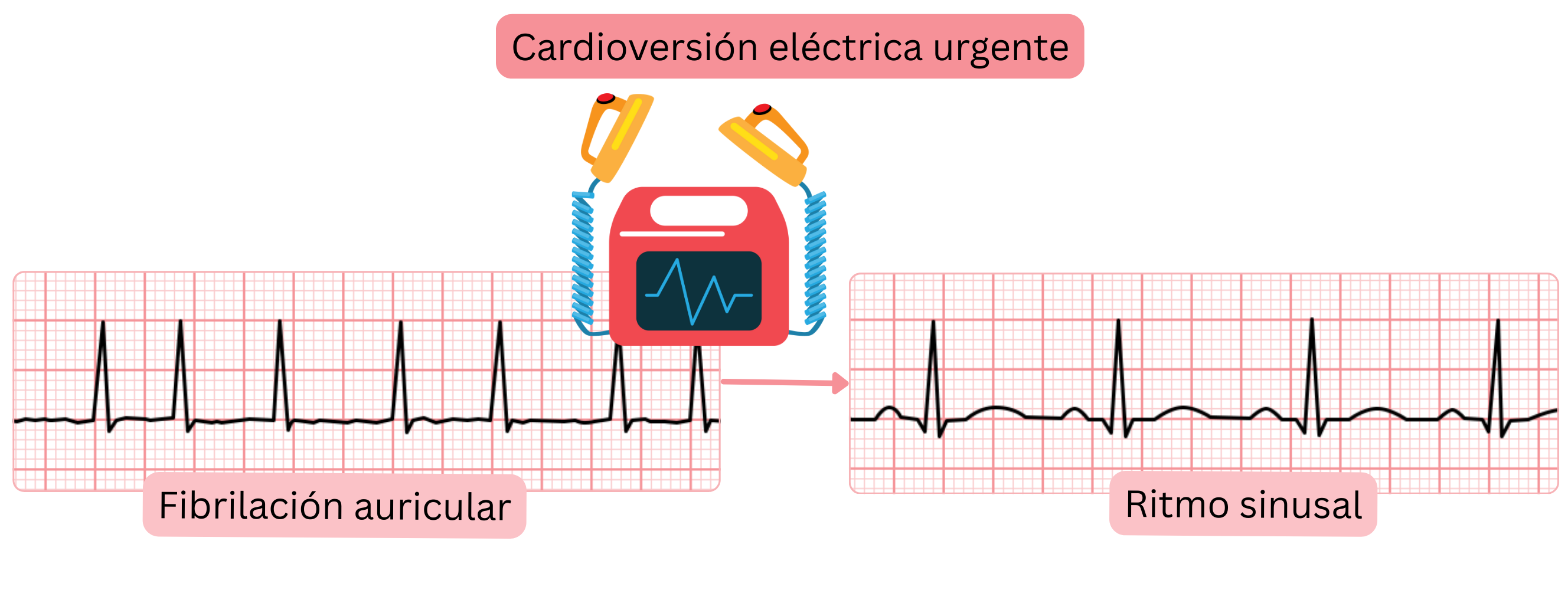 Esquema de la cardioversión eléctrica urgente que muestra la restauración inmediata del ritmo sinusal en la fibrilación auricular mediante una descarga eléctrica sincronizada.