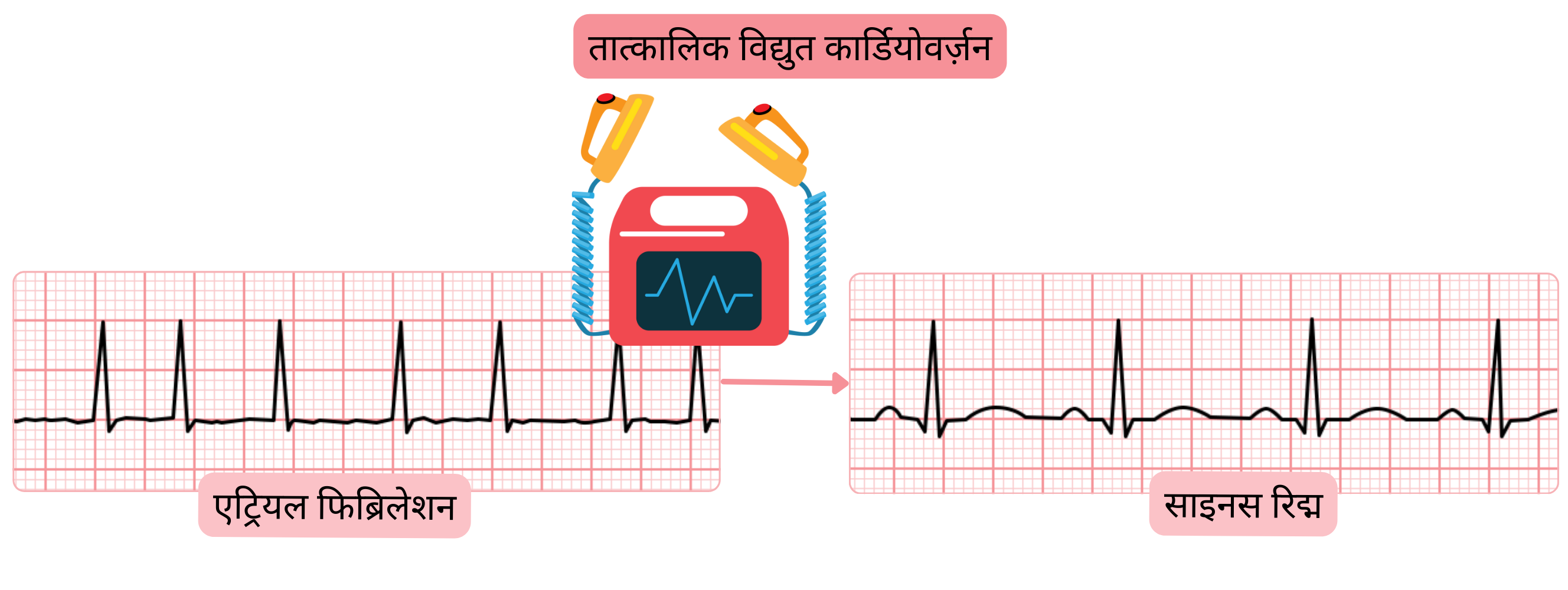तत्काल इलेक्ट्रिकल कार्डियोवर्ज़न का आरेख, जिसमें सिंक्रोनाइज़्ड इलेक्ट्रिक शॉक द्वारा एट्रियल फिब्रिलेशन में साइनस रिद्म की त्वरित बहाली दर्शाई गई है।
