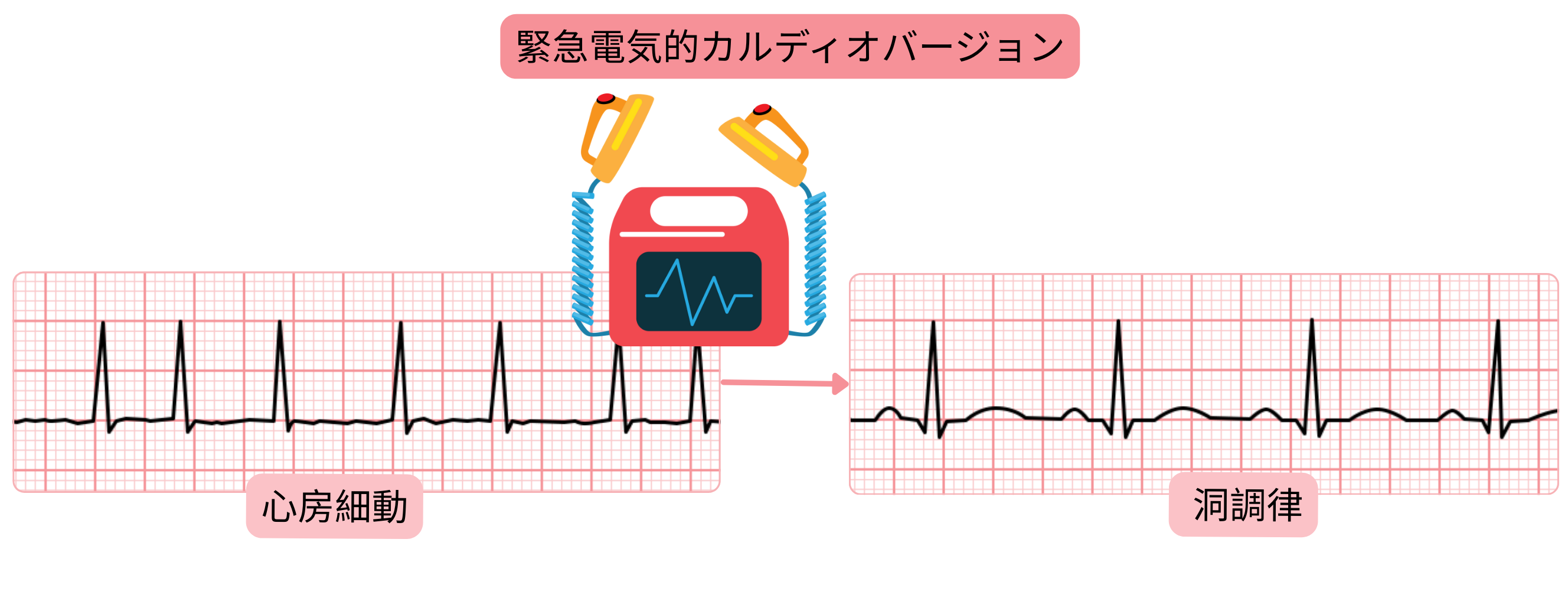 同期電気ショックを用いて心房細動における洞調律を即時に回復させる緊急電気的カルディオバージョンを示す模式図。