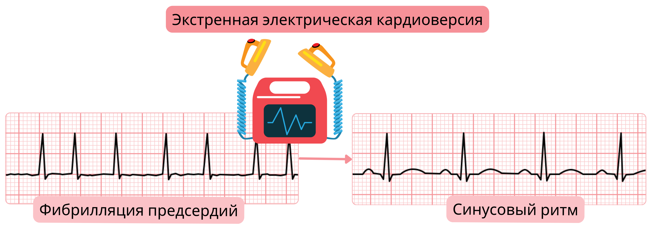 Схема экстренной электрической кардиоверсии, демонстрирующая немедленное восстановление синусового ритма при фибрилляции предсердий с использованием синхронизированного электрического разряда.