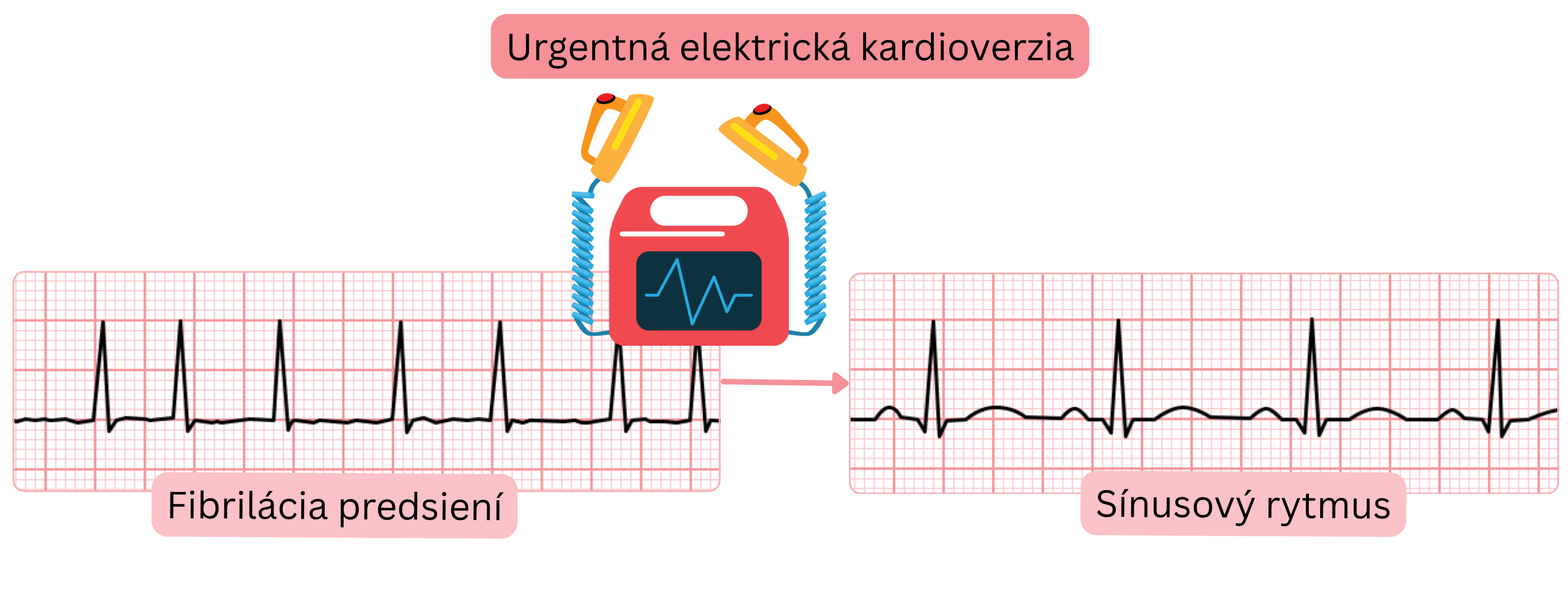 Schéma urgentnej elektrickej kardioverzie znázorňujúca okamžité obnovenie sínusového rytmu pri fibrilácii predsiení pomocou synchronizovaného elektrického výboja.