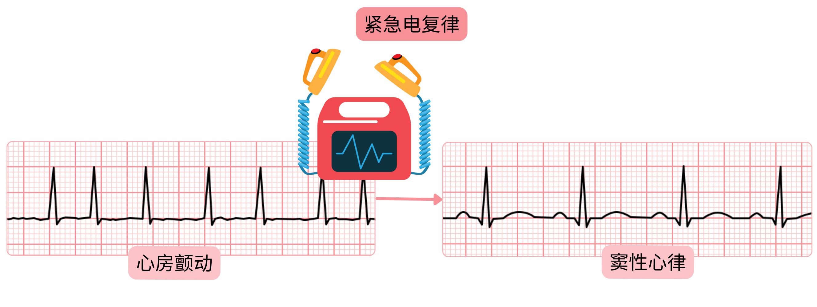 紧急电复律示意图，显示通过同步电击在心房颤动中立即恢复窦性心律。