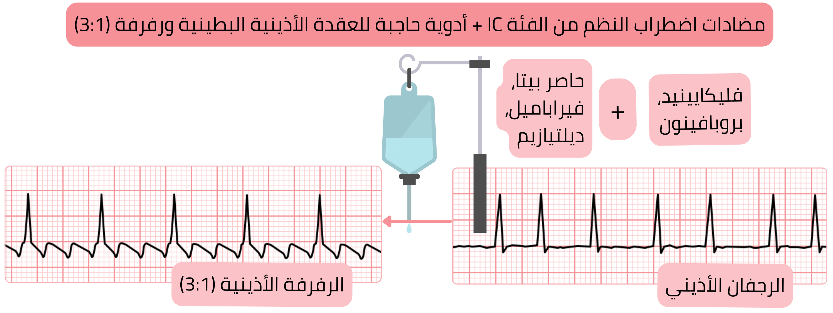مخطط الجمع بين مضادات اضطراب النظم من الفئة IC والأدوية الحاصرة للعقدة الأذينية البطينية يوضح تحول الرجفان الأذيني إلى رفرفة أذينية مع توصيل أذيني بطيني بنسبة 3:1.