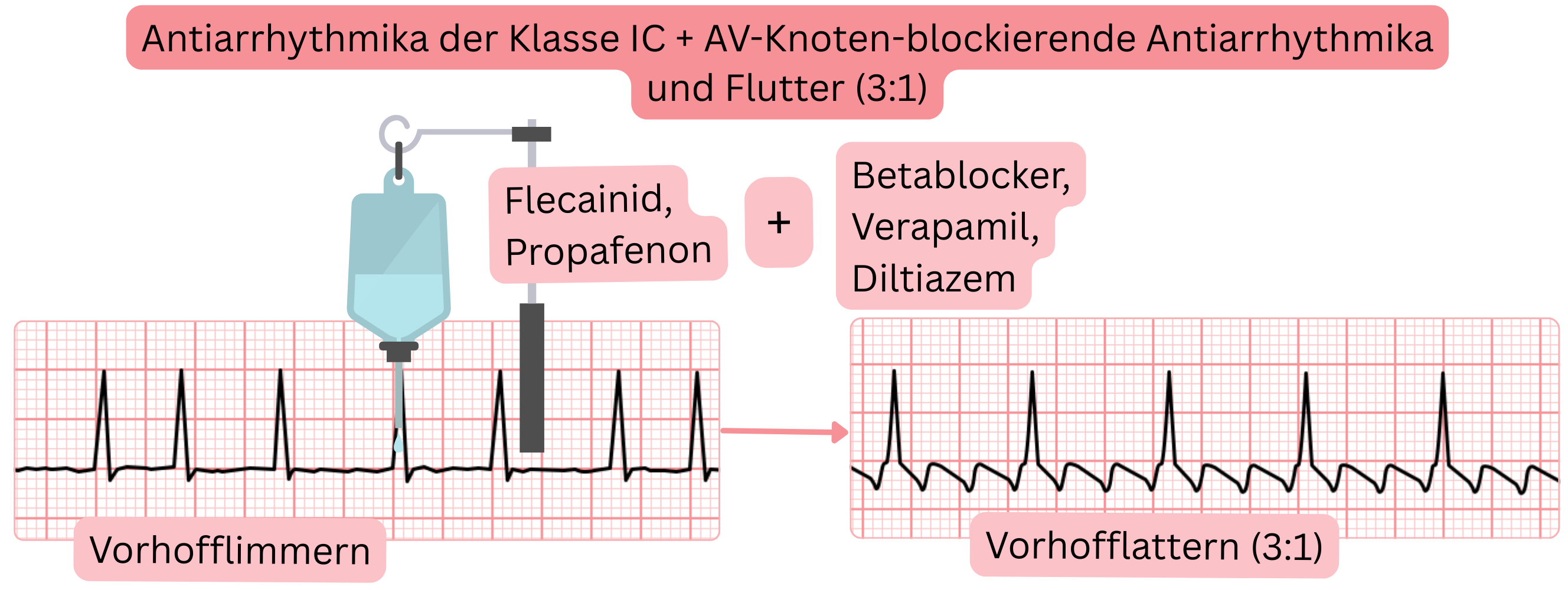 Schema der Kombination von Antiarrhythmika der Klasse IC mit AV-knotenblockierenden Medikamenten, das den Übergang von Vorhofflimmern zu Vorhofflattern mit 3:1-Überleitung darstellt.