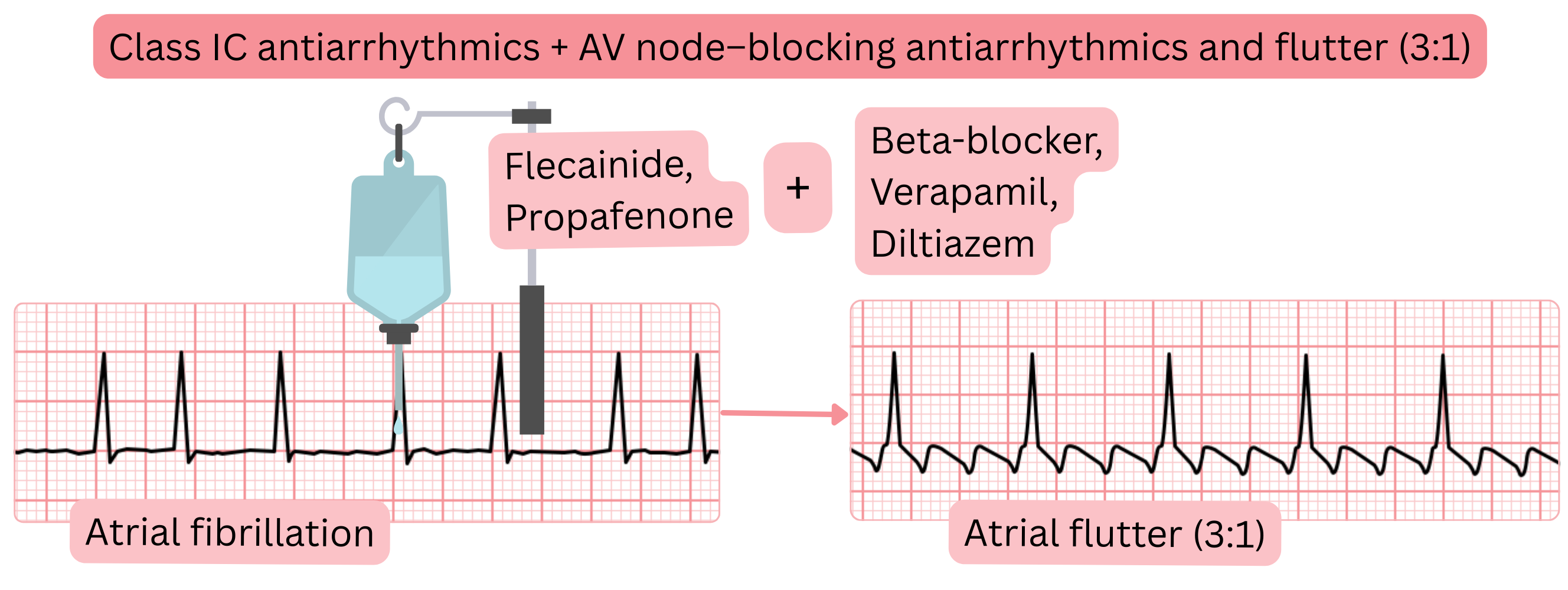 Diagram illustrating combination therapy with class IC antiarrhythmic drugs and AV nodal blocking agents showing conversion of atrial fibrillation into atrial flutter with 3:1 atrioventricular conduction.
