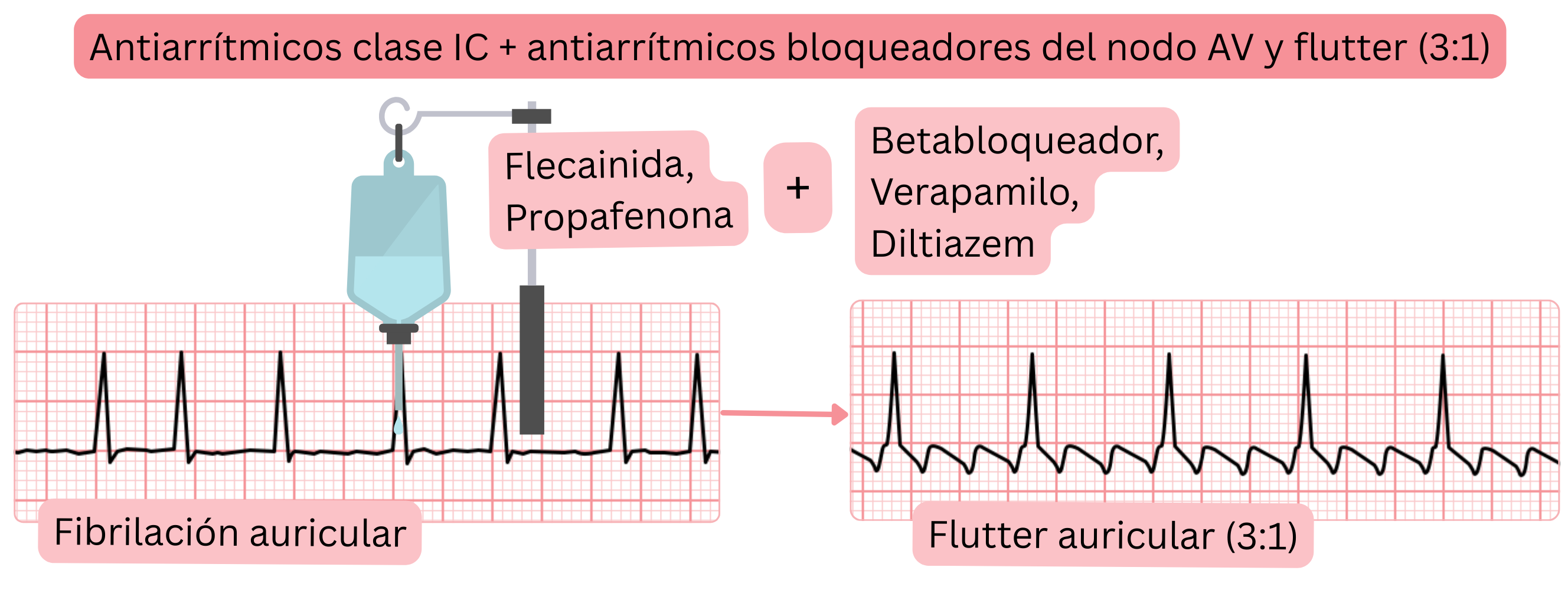 Esquema de la combinación de antiarrítmicos de clase IC con fármacos bloqueadores del nodo AV que muestra la transición de fibrilación auricular a flutter auricular con conducción 3:1.