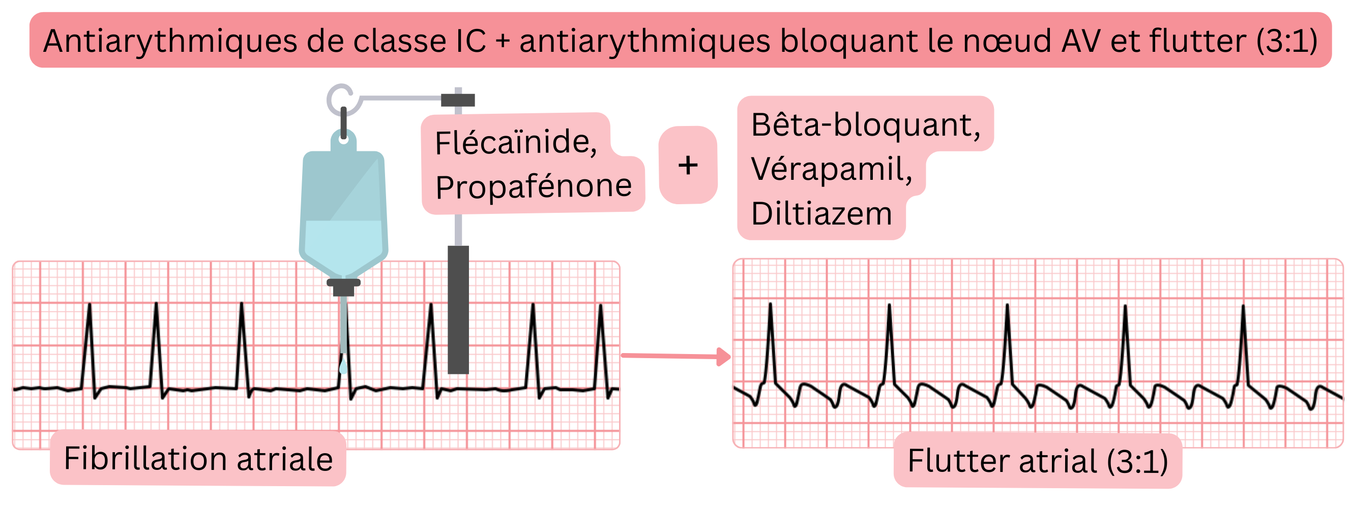 Schéma de la combinaison d’antiarythmiques de classe IC avec des médicaments bloquant le nœud AV illustrant la transformation de la fibrillation auriculaire en flutter auriculaire avec conduction 3:1.