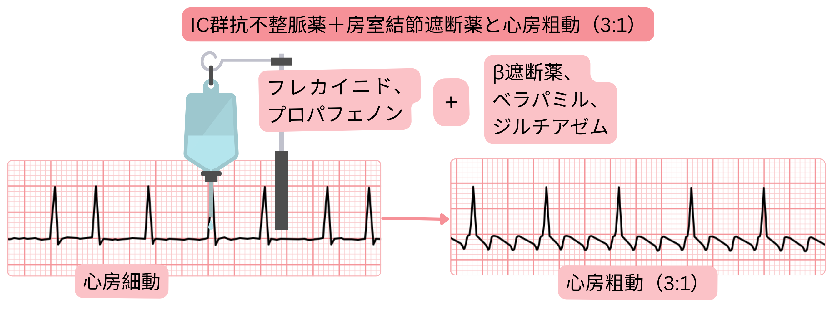 IC群抗不整脈薬と房室結節抑制薬の併用により、心房細動が3:1房室伝導を伴う心房粗動へ移行することを示す模式図。
