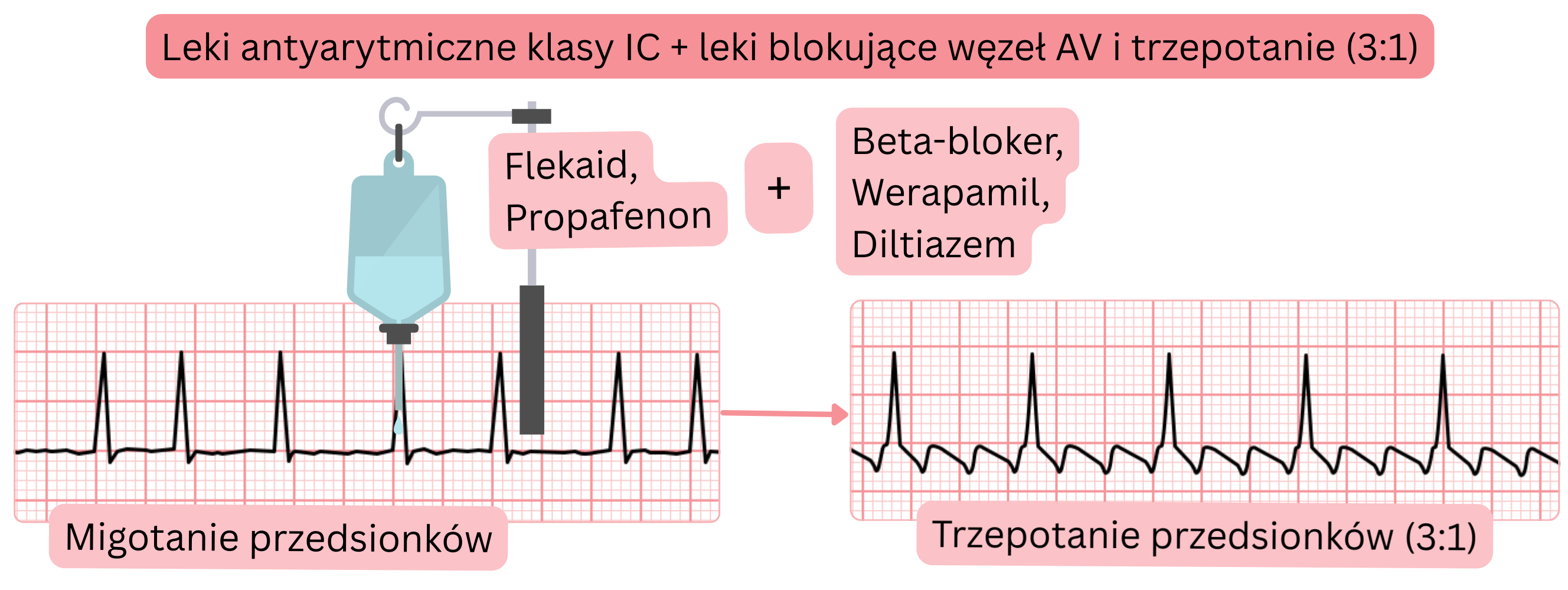 Schemat połączenia leków antyarytmicznych klasy IC z lekami blokującymi węzeł AV, przedstawiający przejście migotania przedsionków w trzepotanie przedsionków z przewodzeniem 3:1.