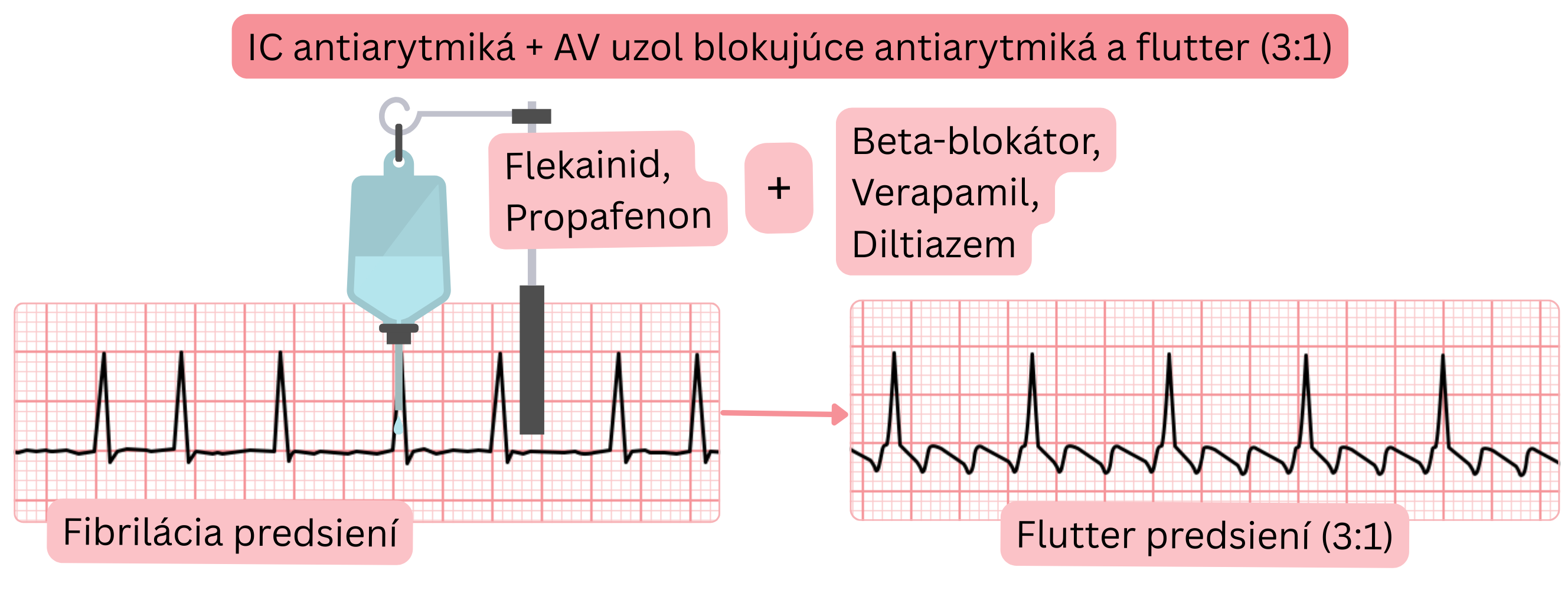 Schéma kombinácie antiarytmík triedy IC s AV-uzol blokujúcimi liekmi znázorňujúca prechod fibrilácie predsiení do predsieňového flutteru s vedením 3 : 1.