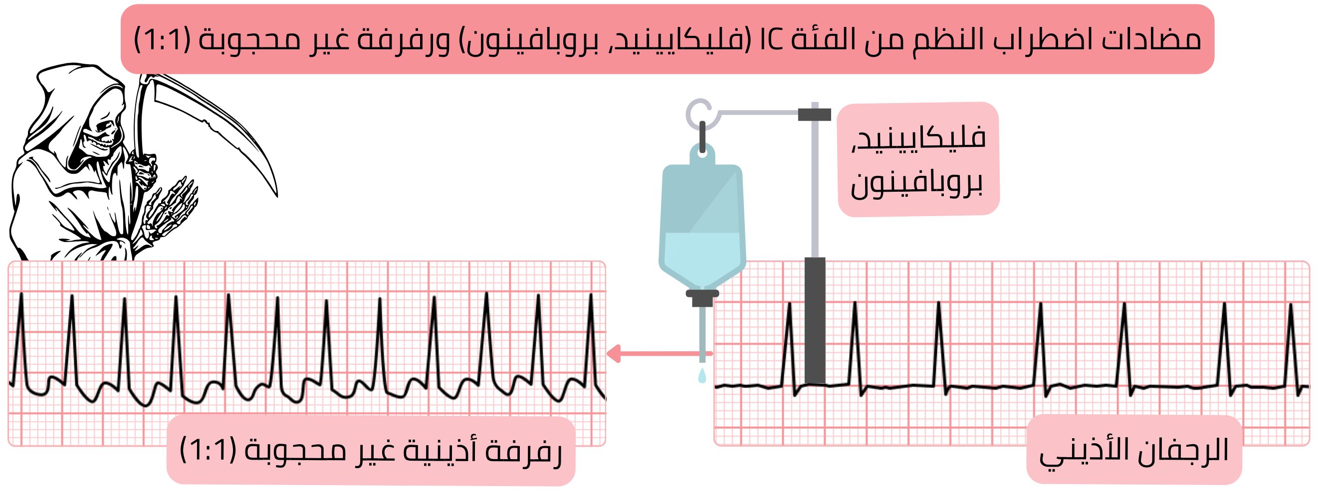 مخطط تأثير مضادات اضطراب النظم من الفئة IC دون حصر متزامن للعقدة الأذينية البطينية يوضح خطر تحول الرجفان الأذيني إلى رفرفة أذينية غير محجوبة مع توصيل 1:1.