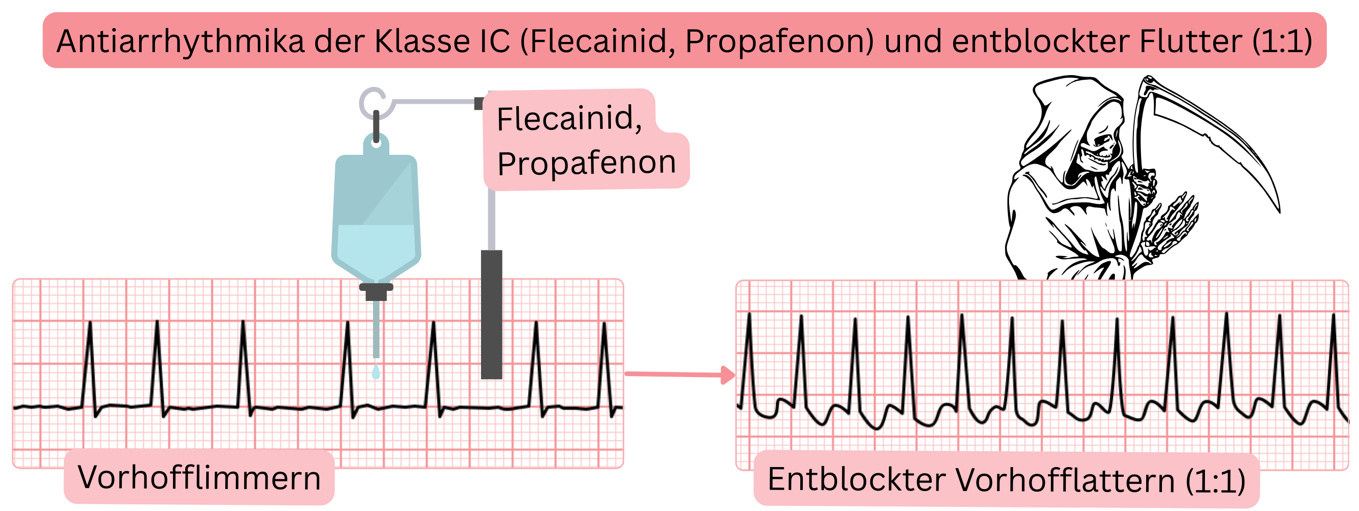 Schema der Wirkung von Antiarrhythmika der Klasse IC ohne gleichzeitige AV-Knoten-Blockade mit Darstellung des Risikos eines Übergangs von Vorhofflimmern zu deblockiertem Vorhofflattern mit 1:1-Überleitung.