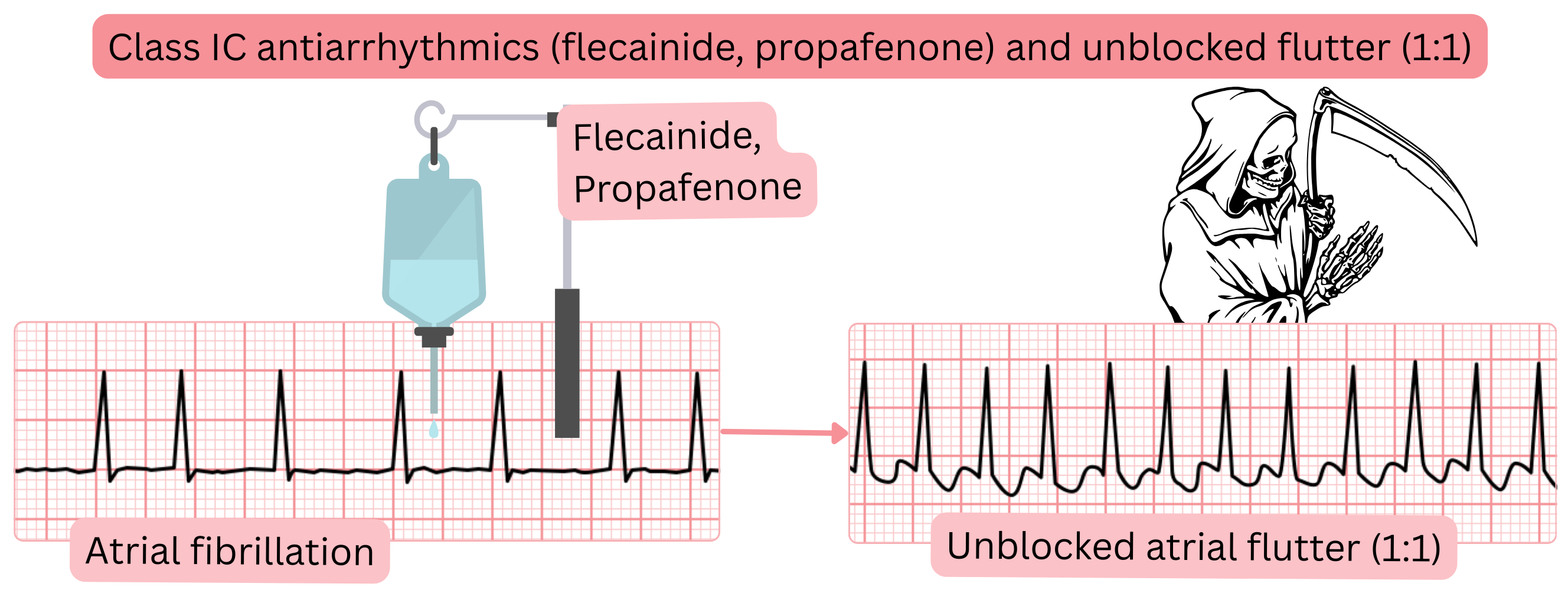 Diagram of the effect of class IC antiarrhythmic drugs without concomitant AV nodal blockade illustrating the risk of conversion of atrial fibrillation to unblocked atrial flutter with 1:1 conduction.